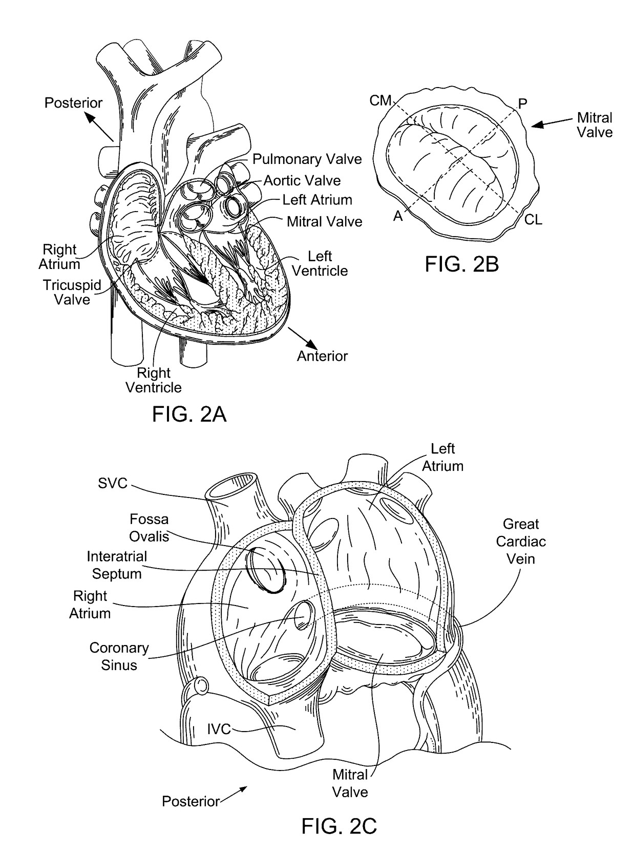 Devices, systems, and methods for reshaping a heart valve annulus