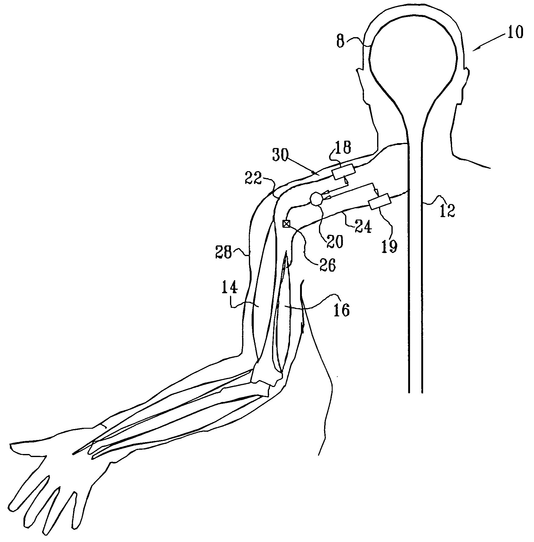 Nerve stimulation for treating spasticity, tremor, muscle weakness, and other motor disorders