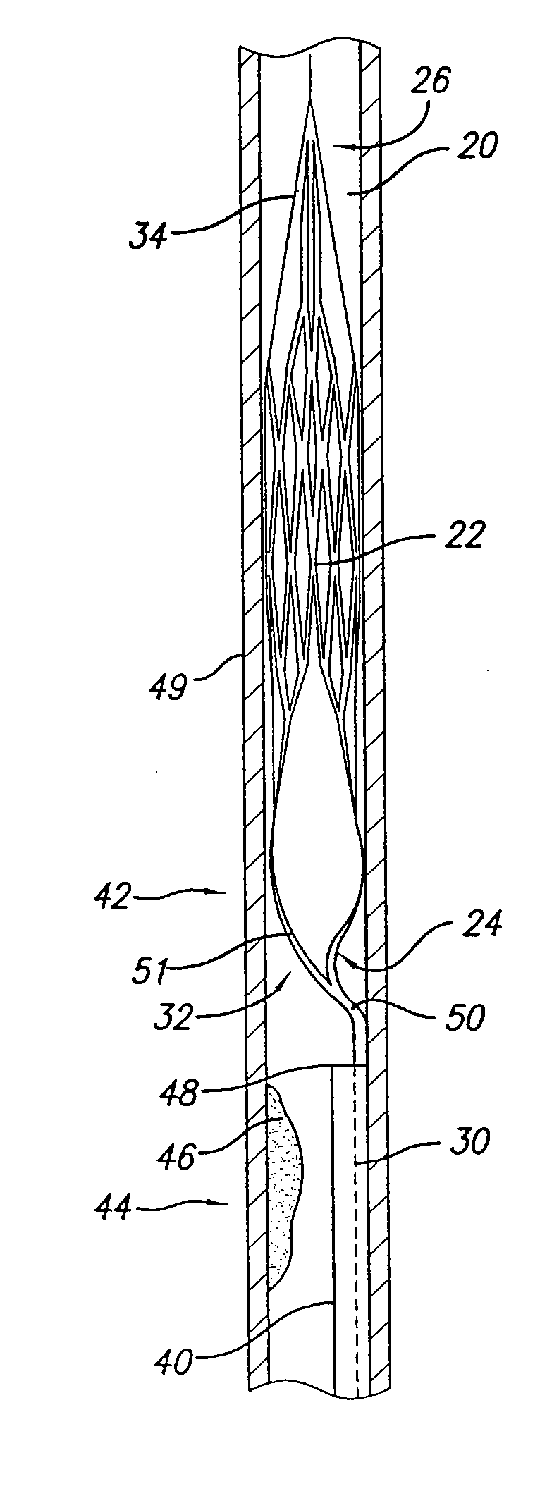 Embolic basket