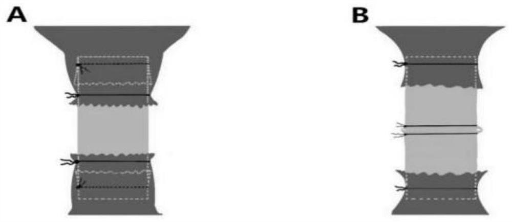 Improved intravenous lining stent rat orthotopic liver transplantation model establishing method