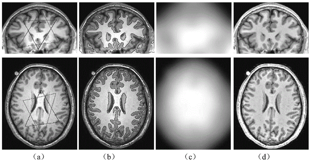 MR image segmentation and displacement field correction method based on geodesic models of local and global areas