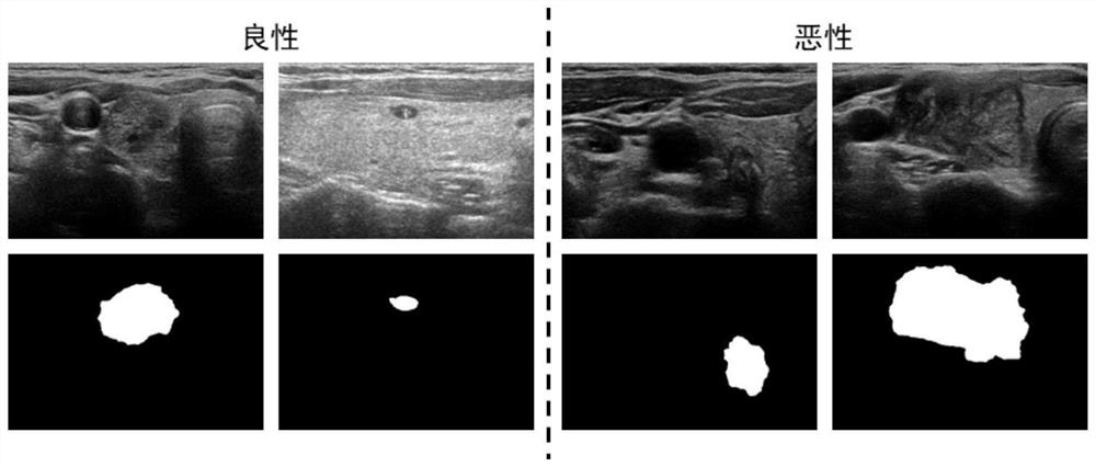 Ultrasonic image thyroid nodule classification method based on feature decoupling
