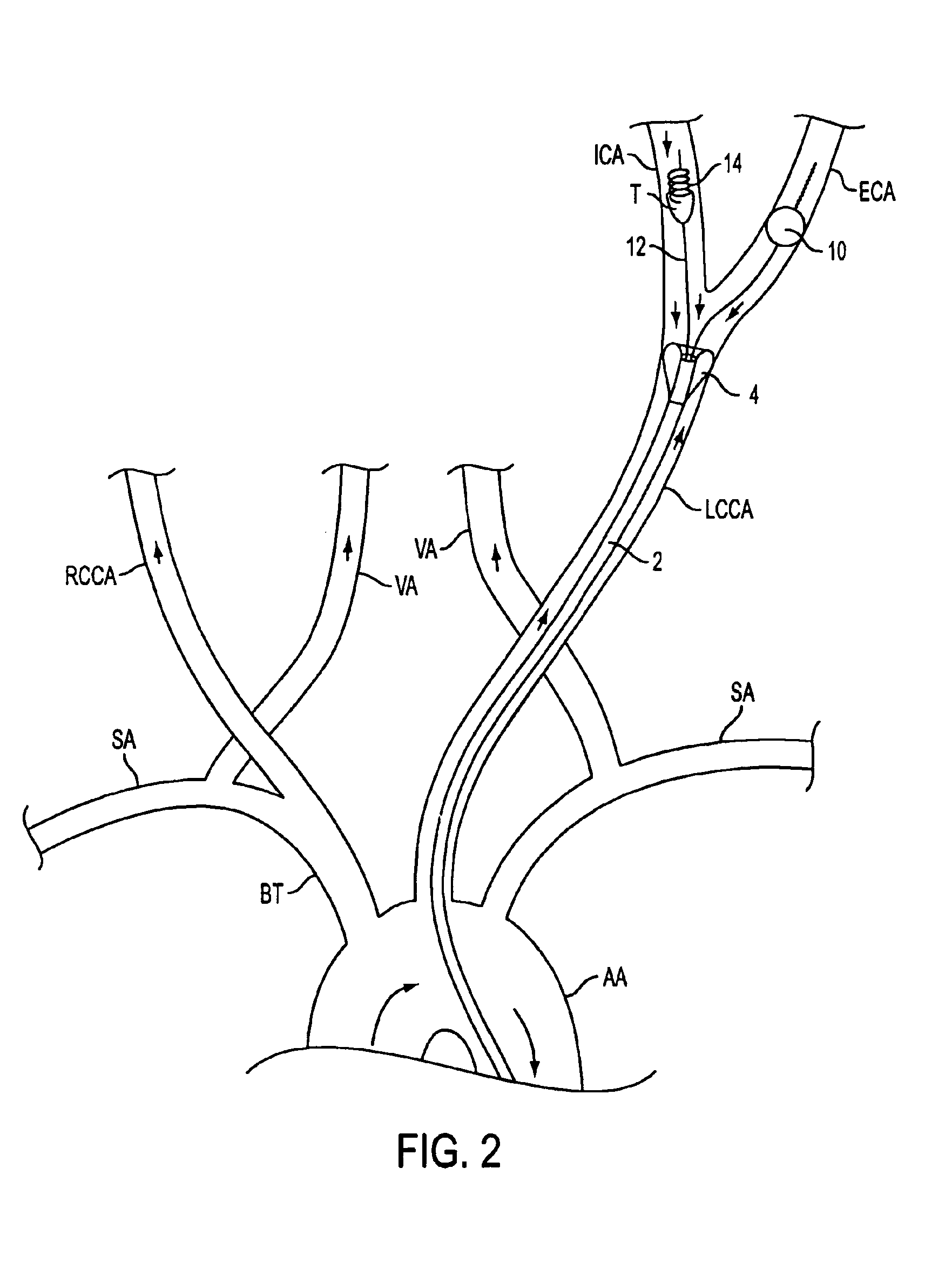 Apparatus and methods for treating stroke and controlling cerebral flow characteristics