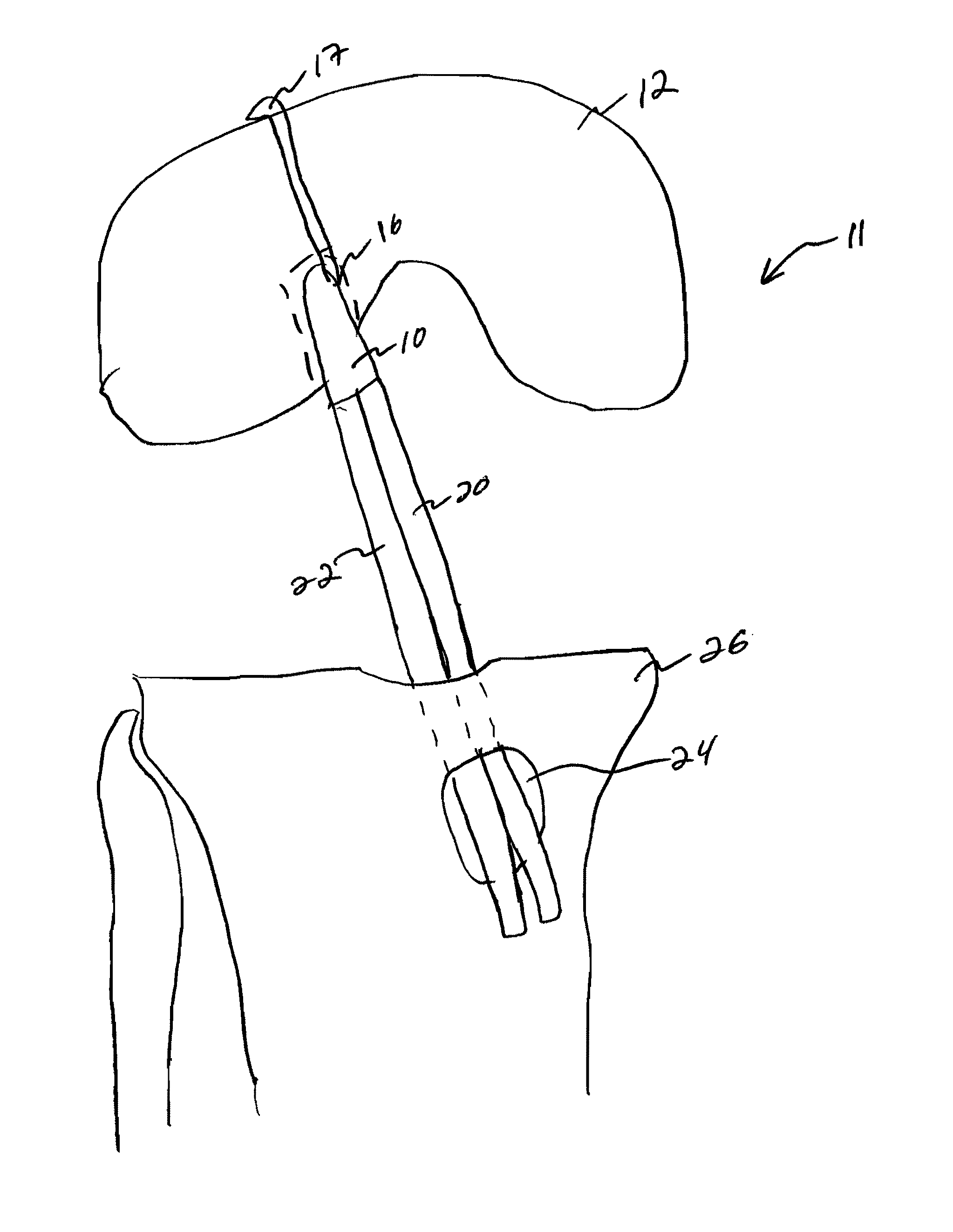 Single tunnel double bundle anterior cruciate ligament reconstruction