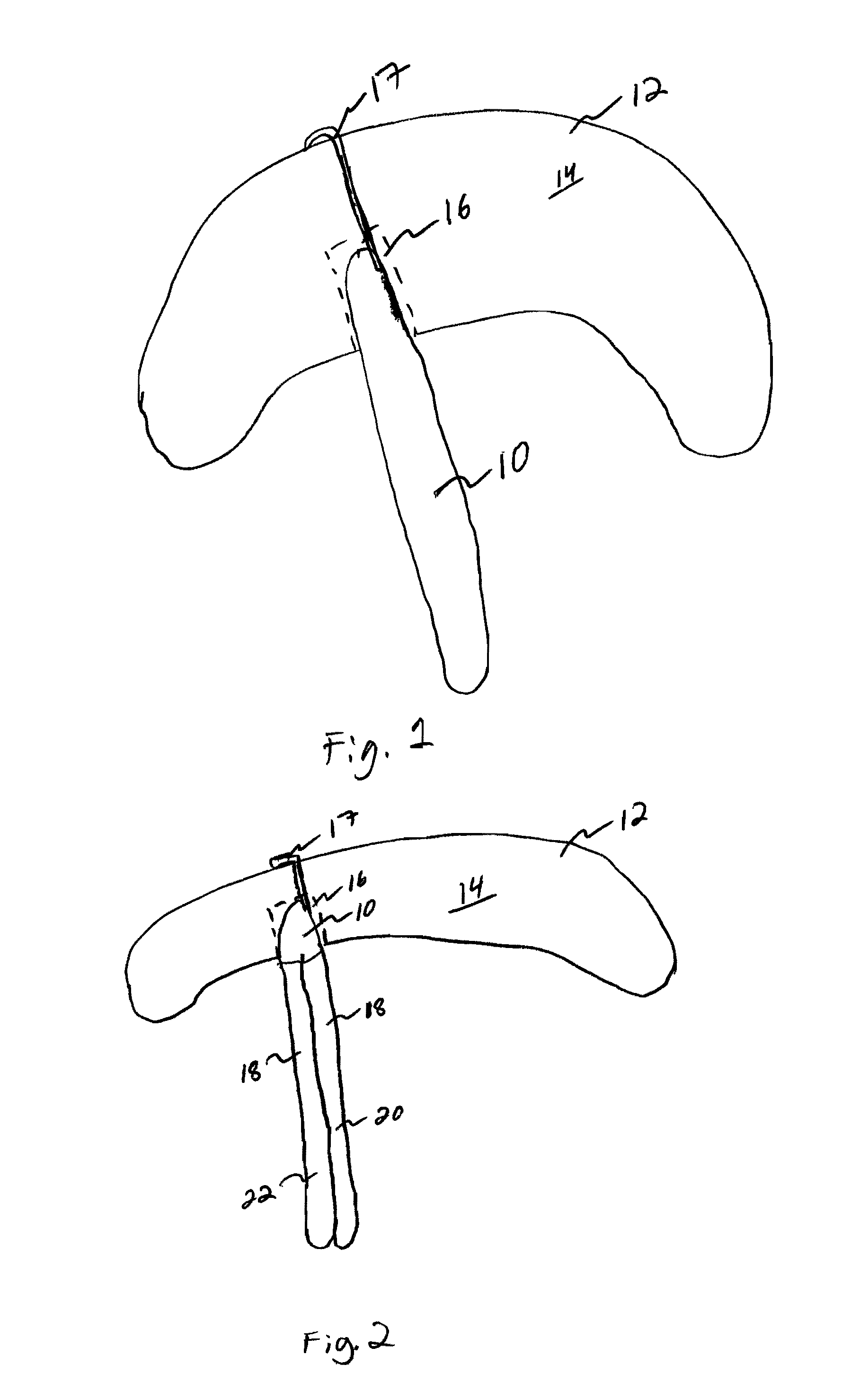 Single tunnel double bundle anterior cruciate ligament reconstruction