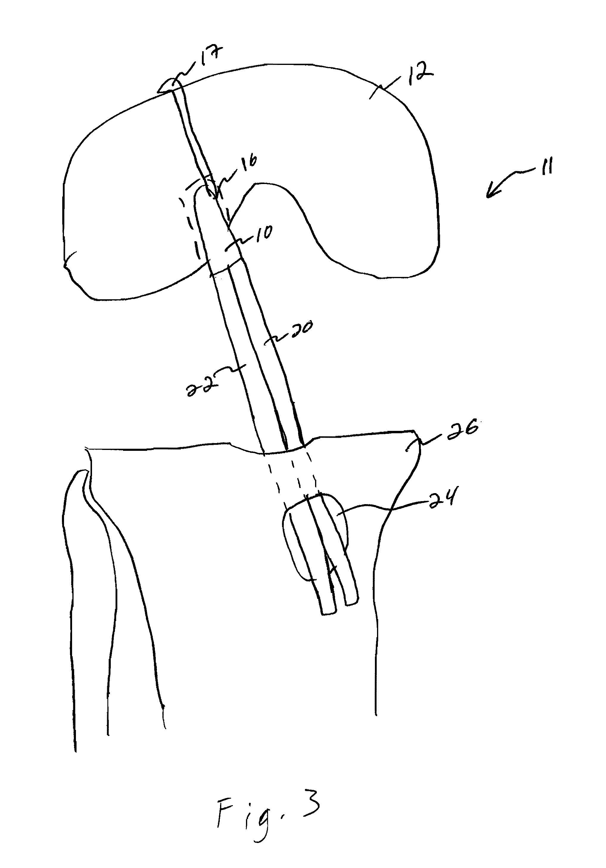 Single tunnel double bundle anterior cruciate ligament reconstruction