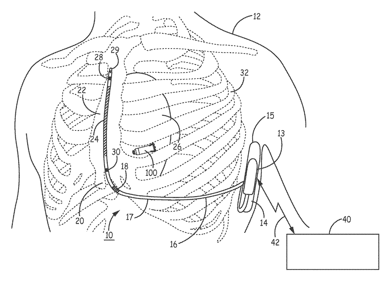 Far-field P-wave sensing in near real-time for timing delivery of pacng therapy in a cardiac medical device and medical device system