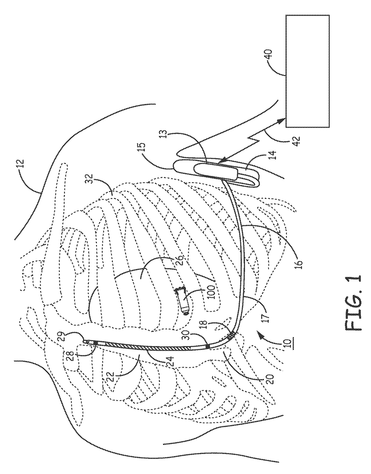 Far-field P-wave sensing in near real-time for timing delivery of pacng therapy in a cardiac medical device and medical device system