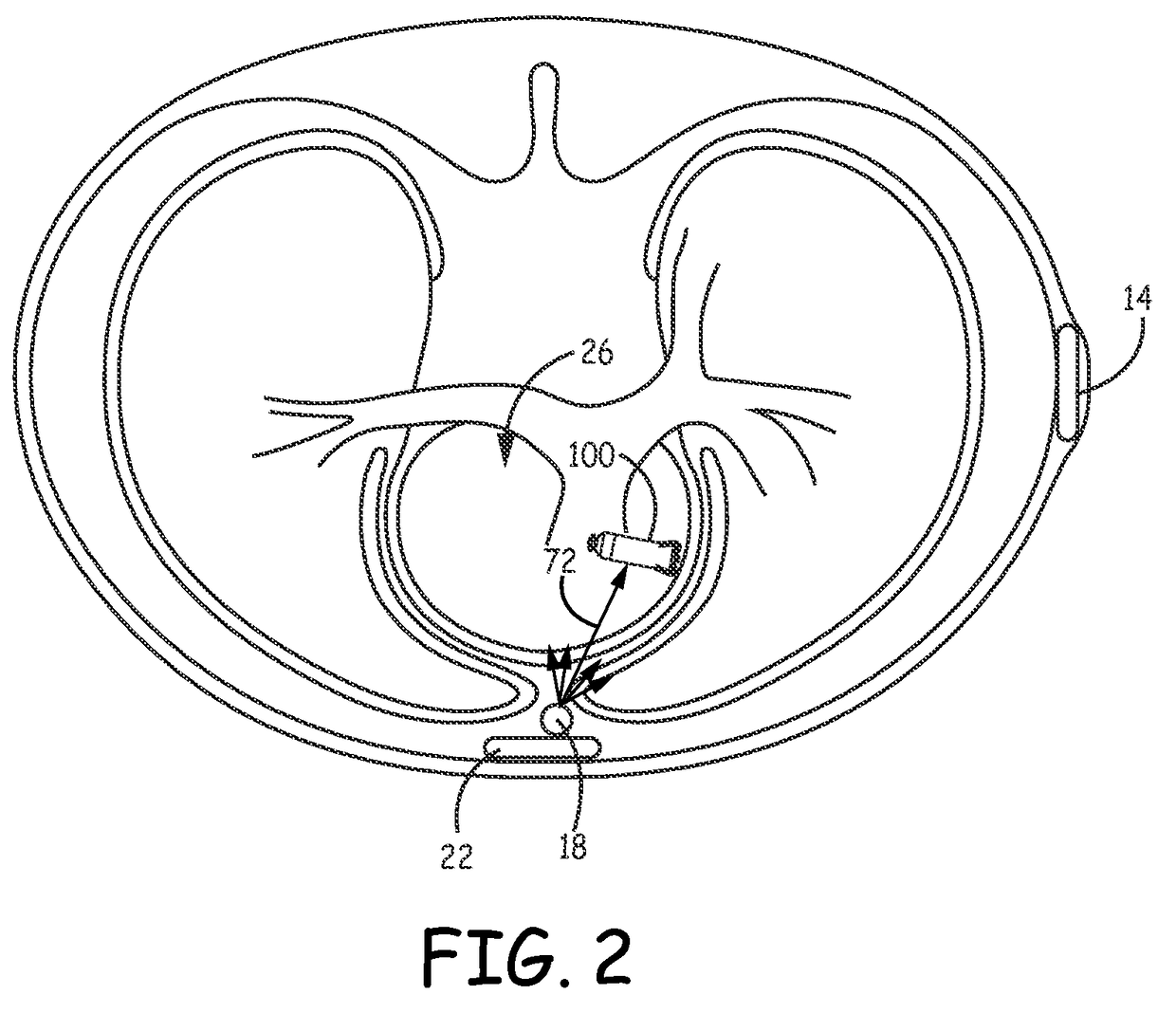 Far-field P-wave sensing in near real-time for timing delivery of pacng therapy in a cardiac medical device and medical device system