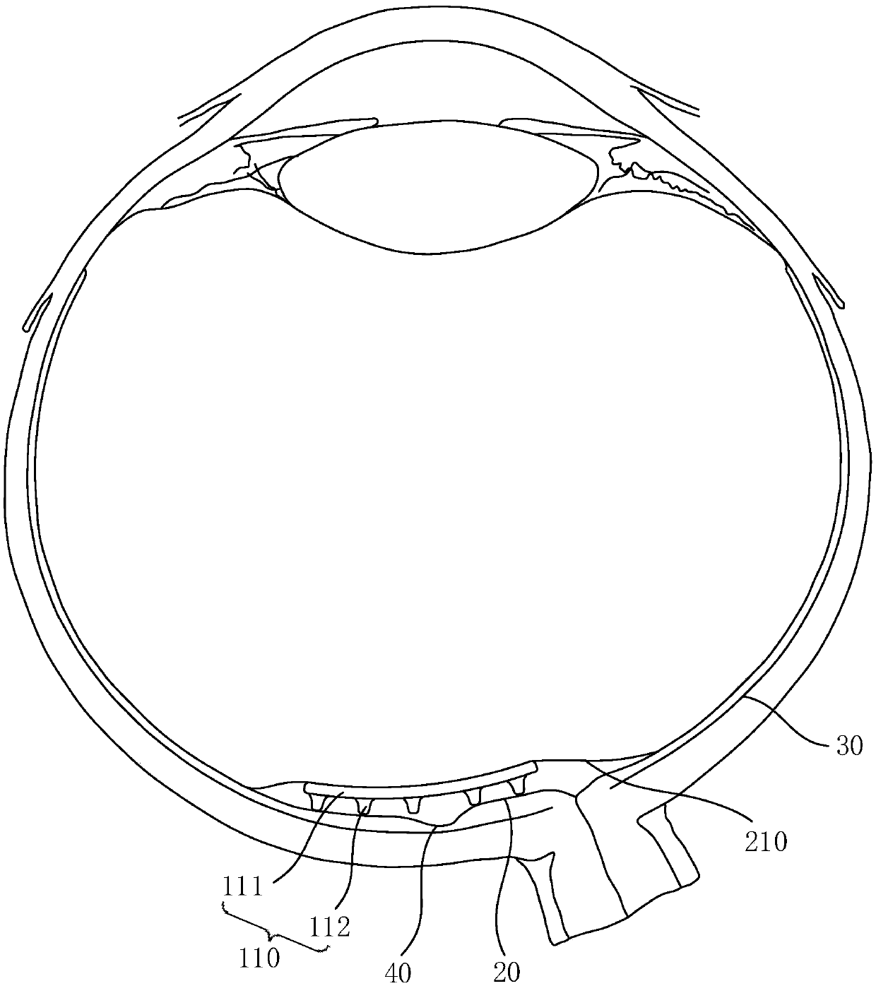 Visual reconstruction device