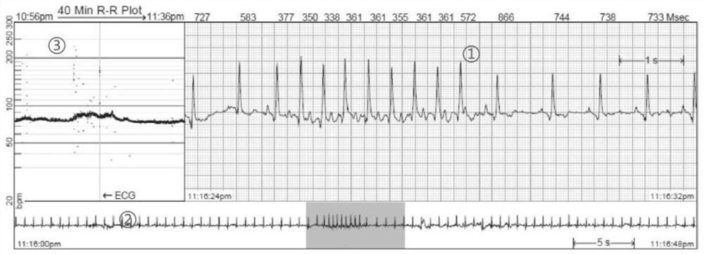 Novel display method of ECG waveform graph bar