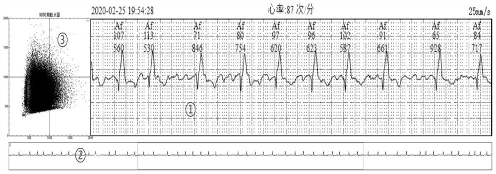 Novel display method of ECG waveform graph bar