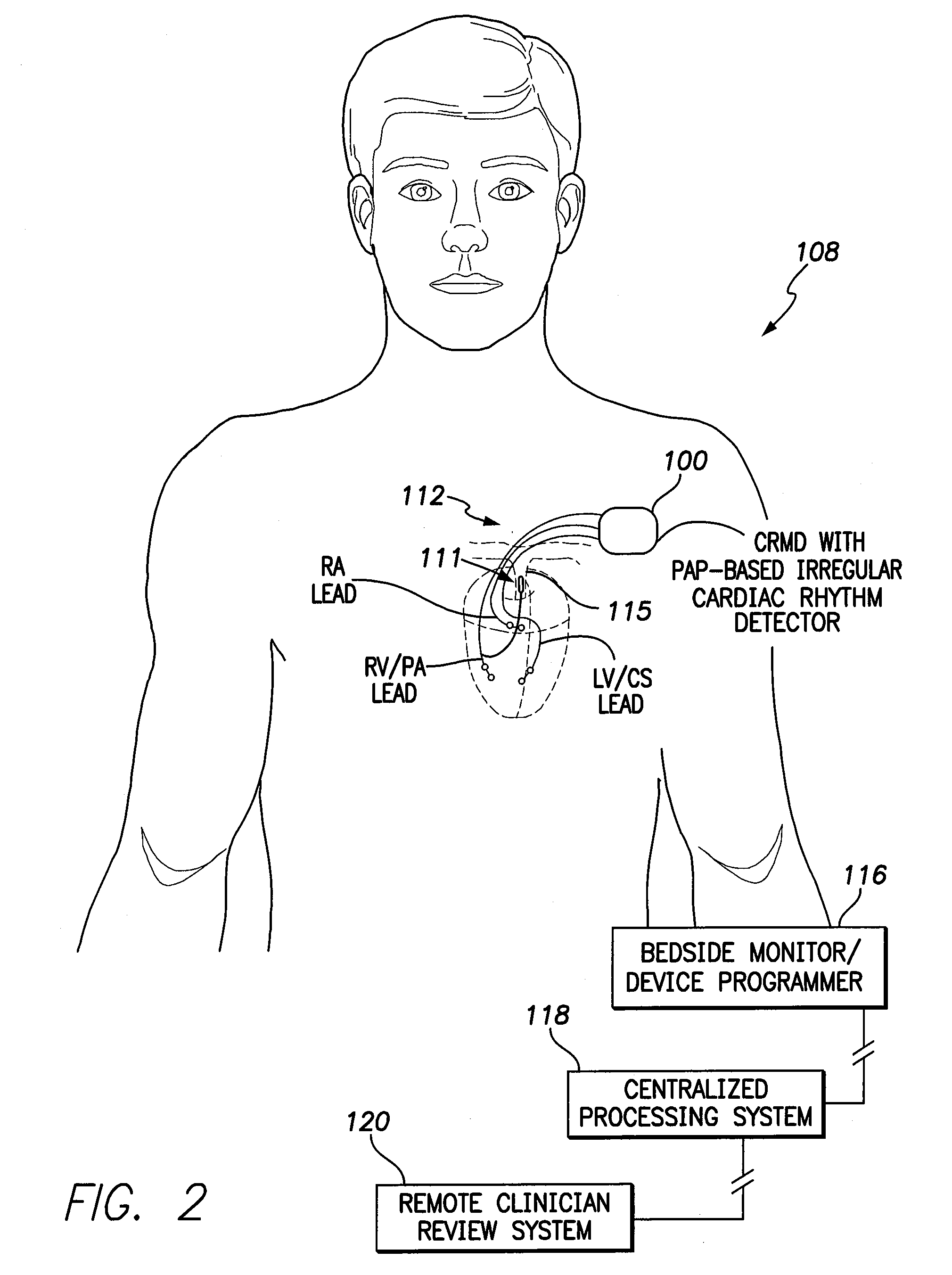 Systems and methods for exploiting pulmonary artery pressure obtained from an implantable sensor to detect cardiac rhythm irregularities