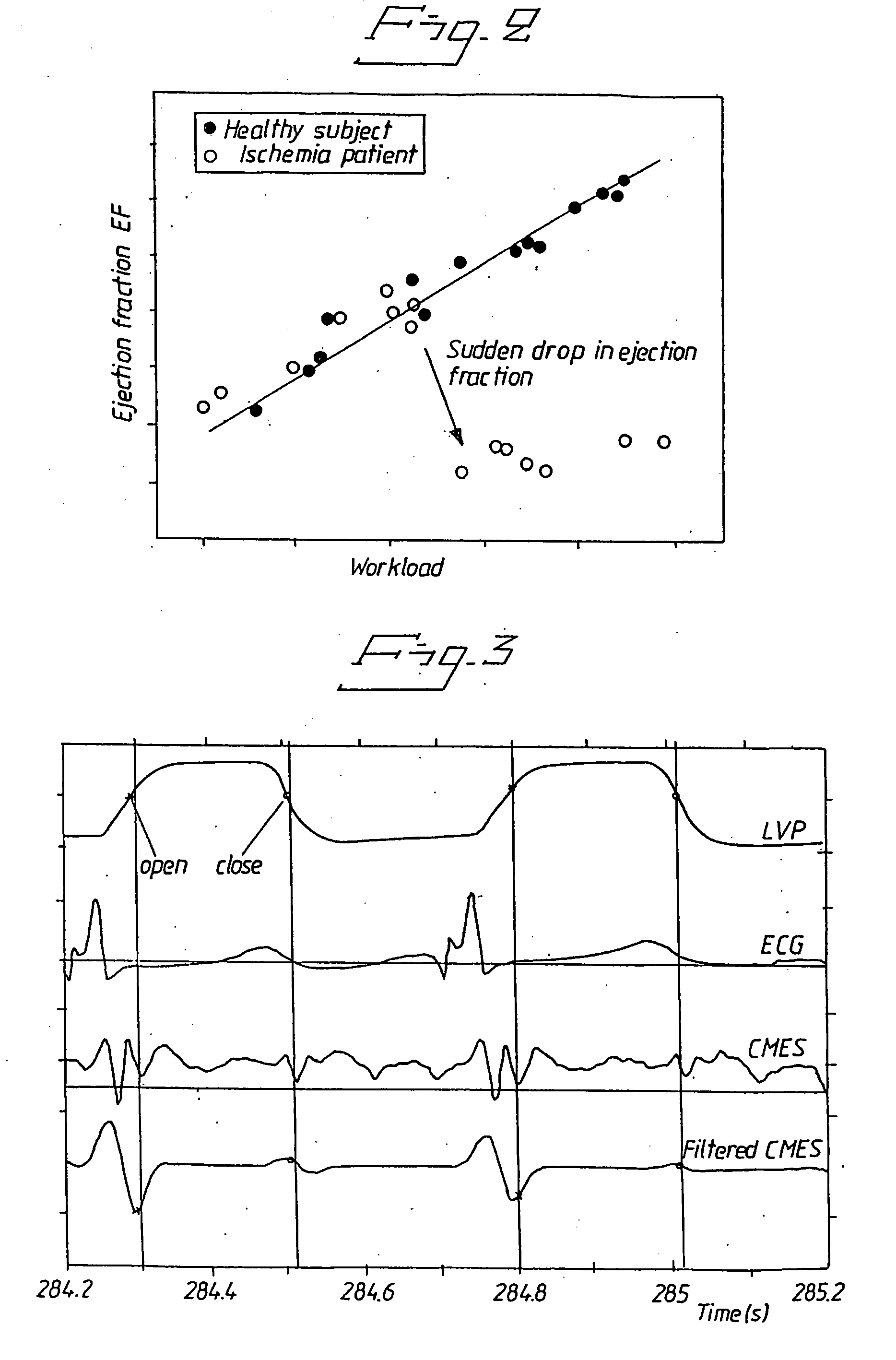 Detection of ischemia