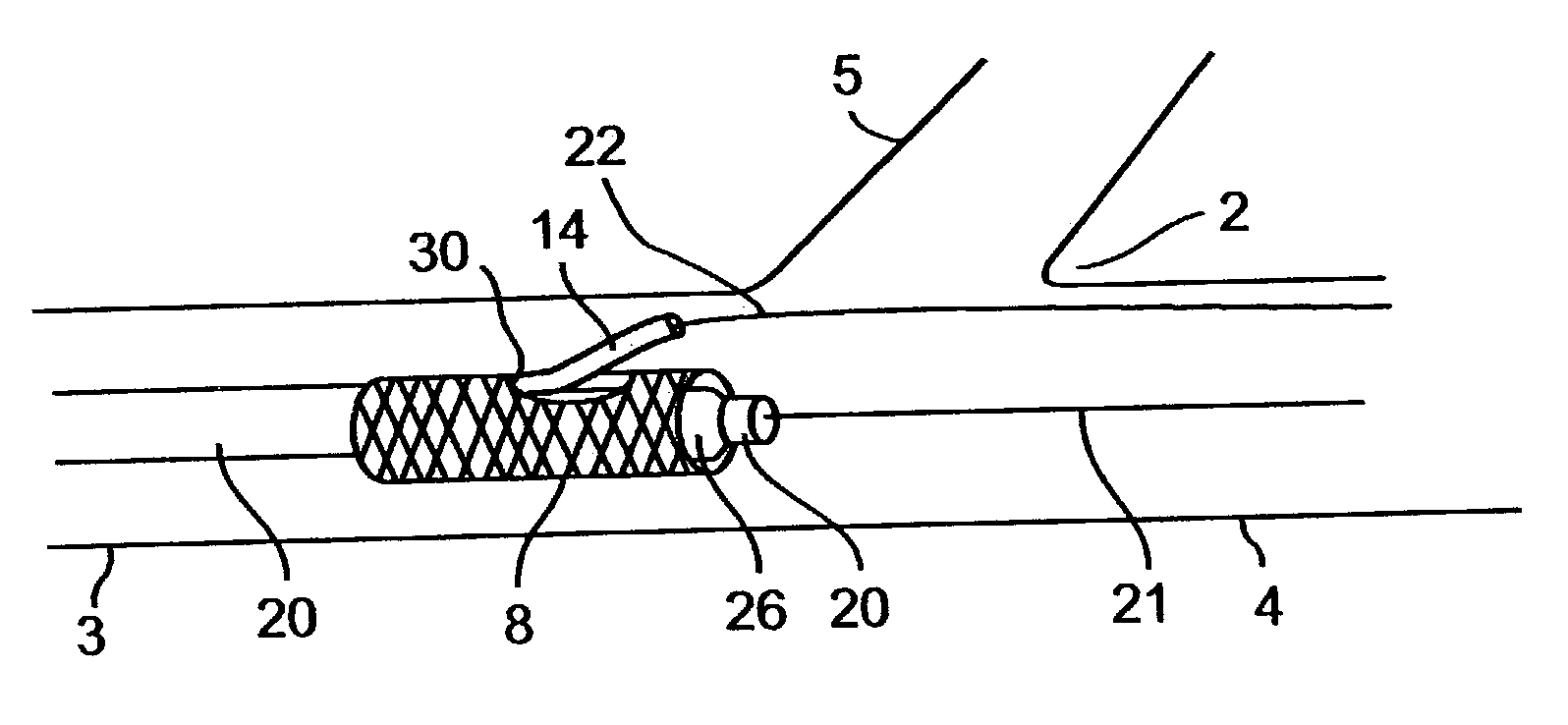 Methods for deploying stents in bifurcations