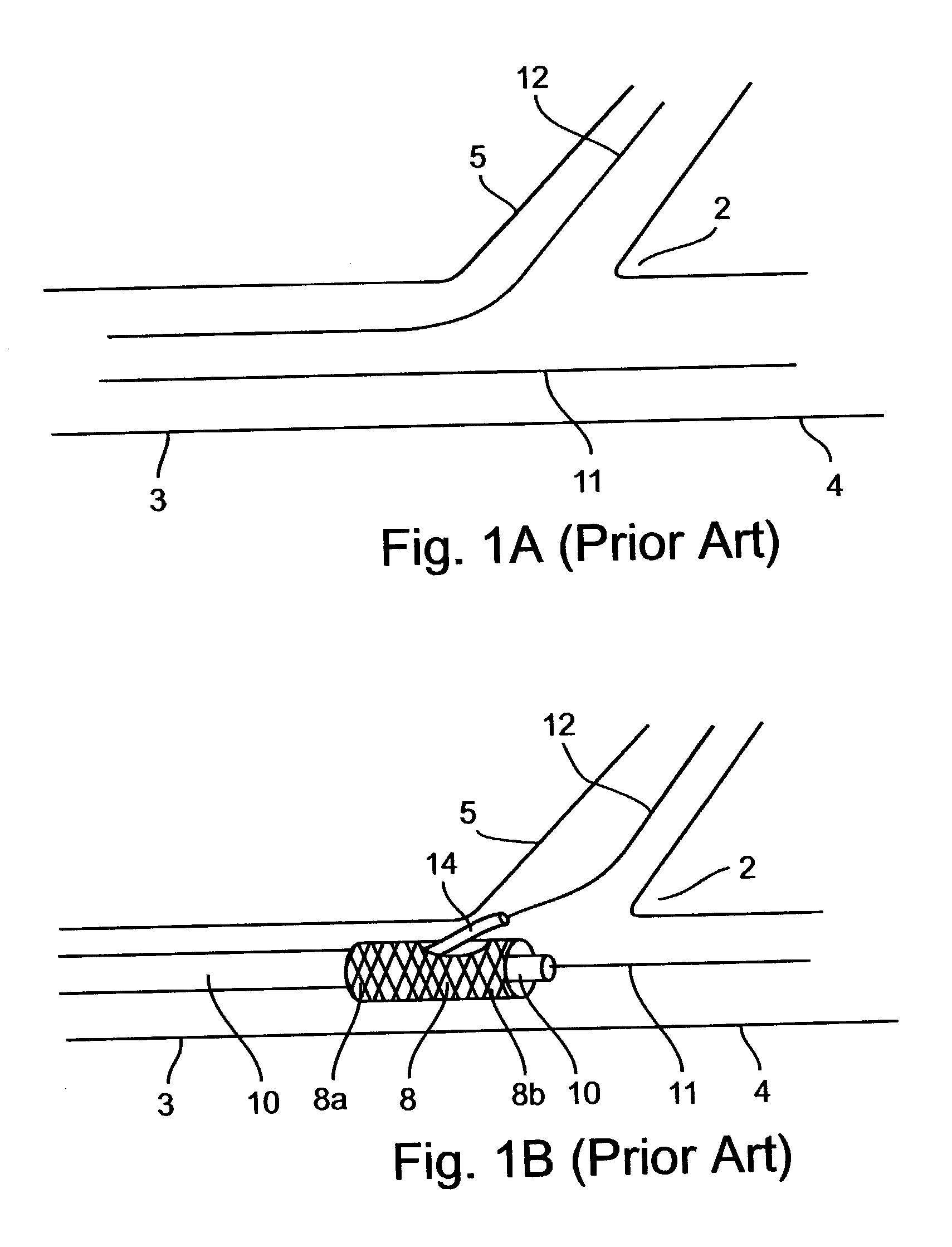 Methods for deploying stents in bifurcations