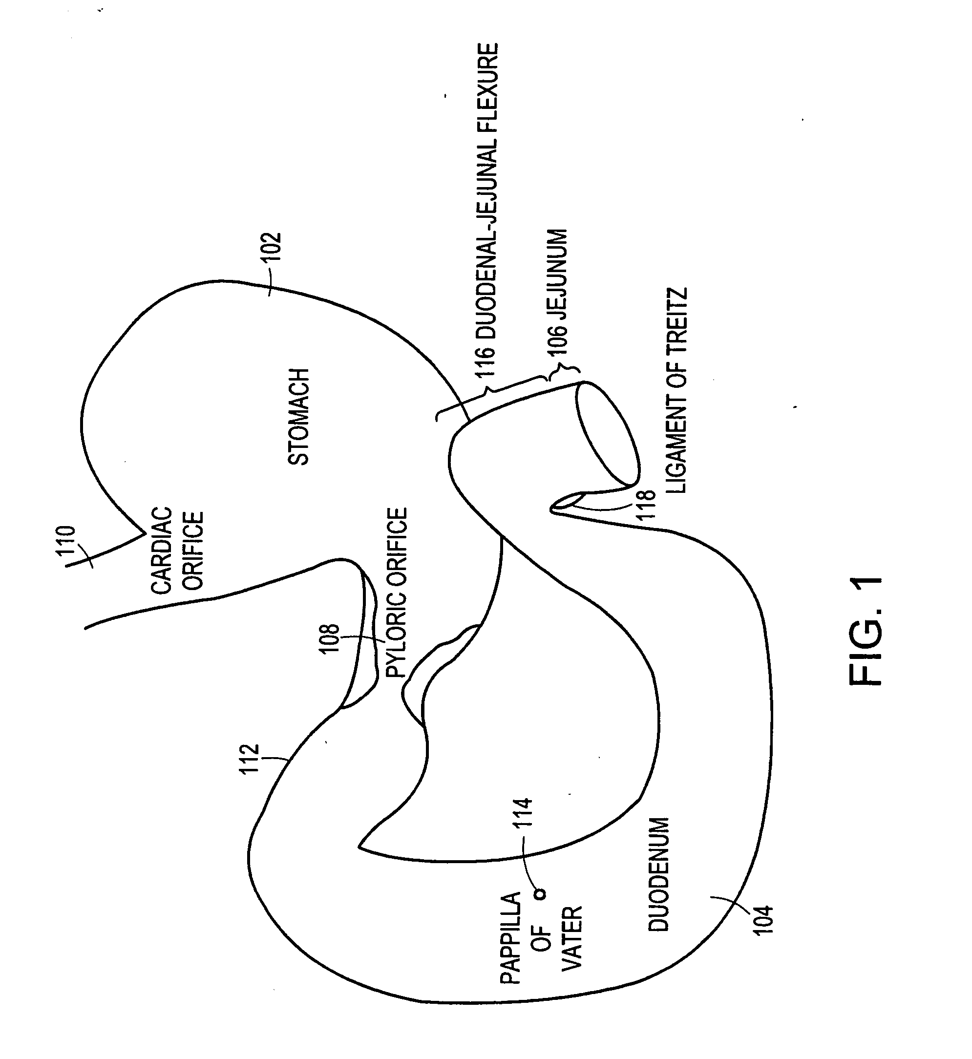 Bariatric sleeve