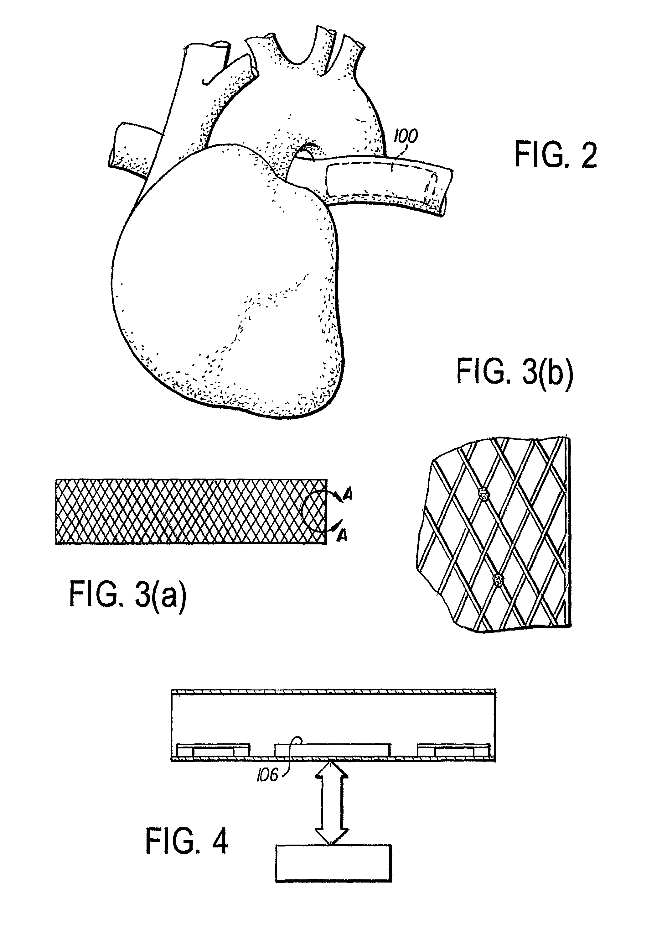 Leadless implantable intravascular electrophysiologic device for neurologic/cardiovascular sensing and stimulation