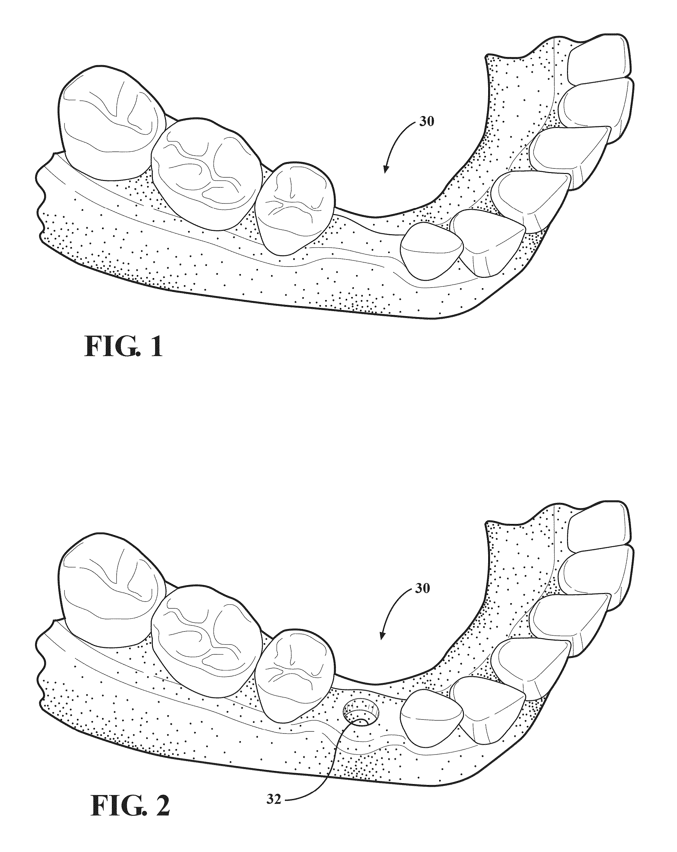 Autografting osteotome