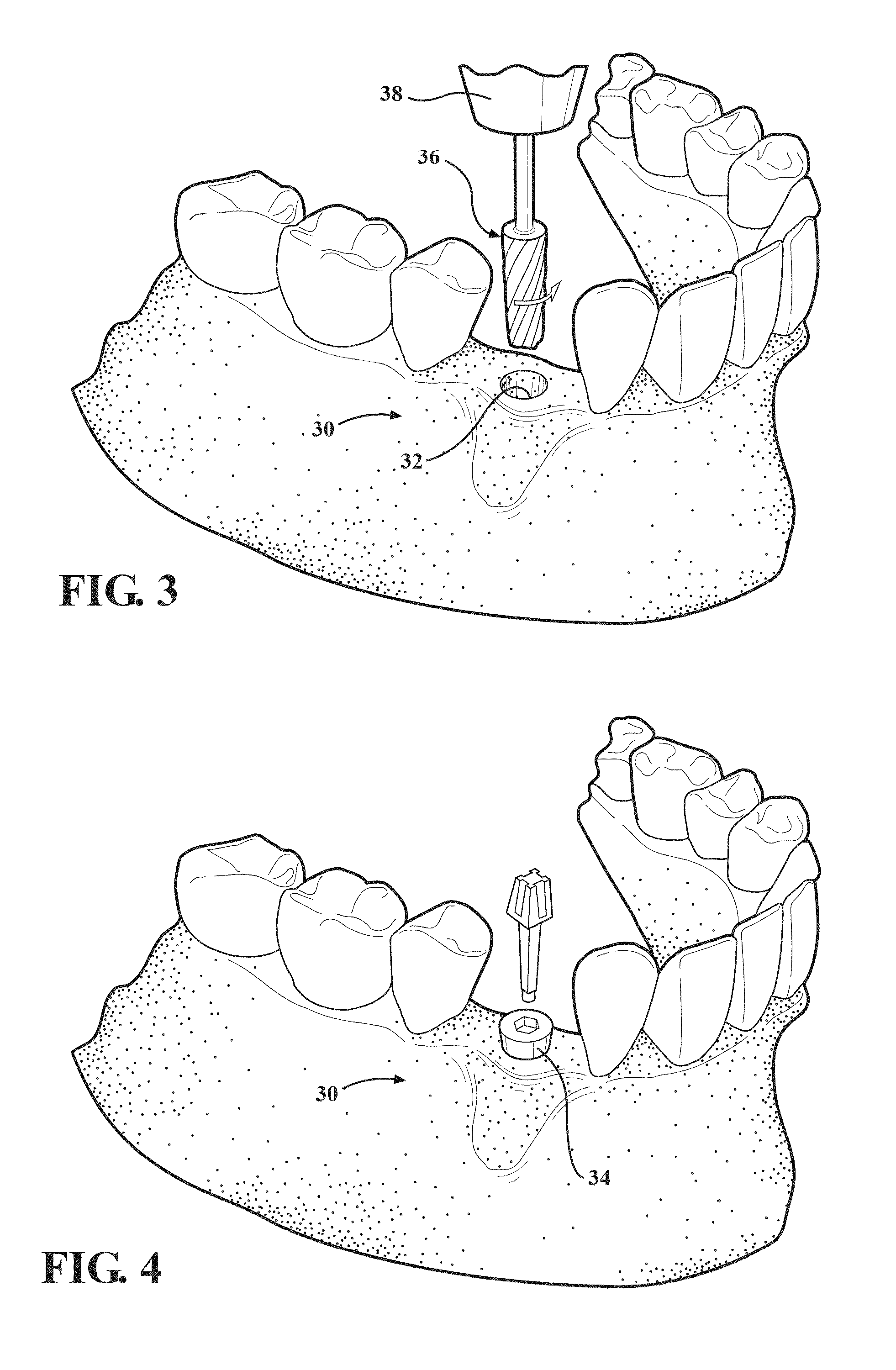 Autografting osteotome