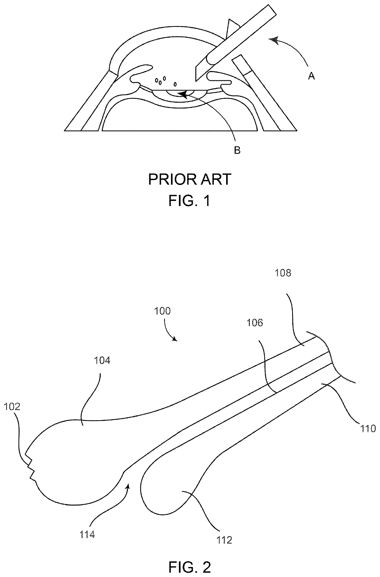 Cataract removal device and integrated tip