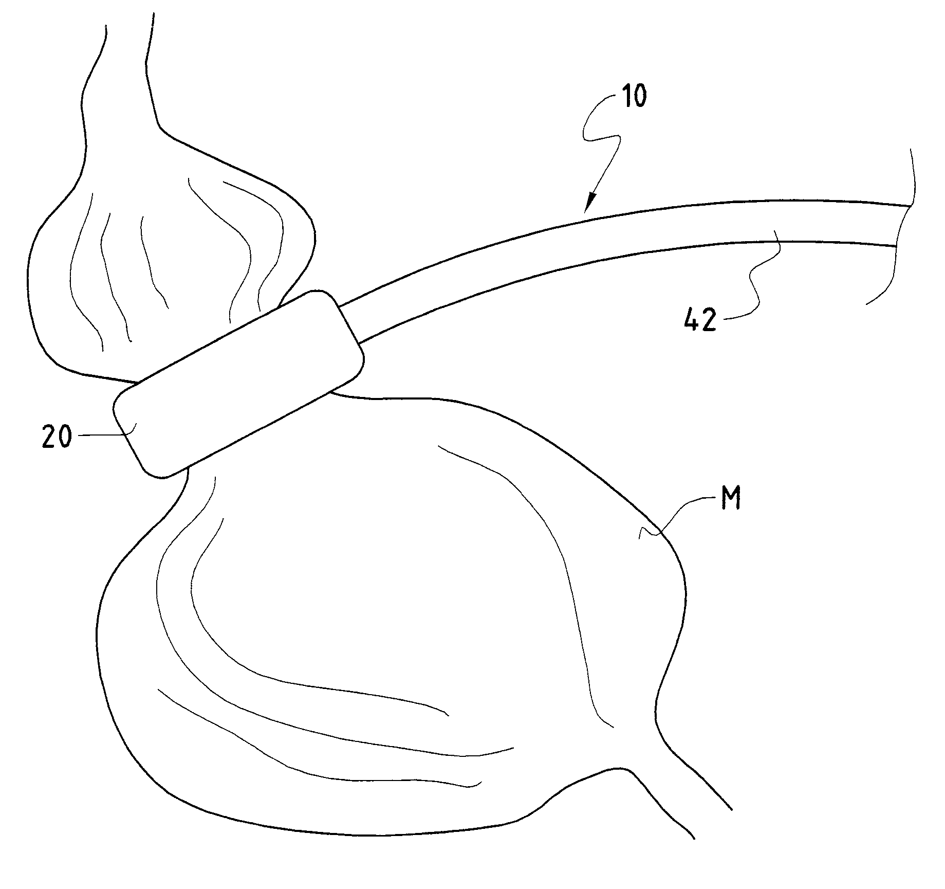 Adaptive device and adaptive method for automatically adapting the stomach opening of a patient