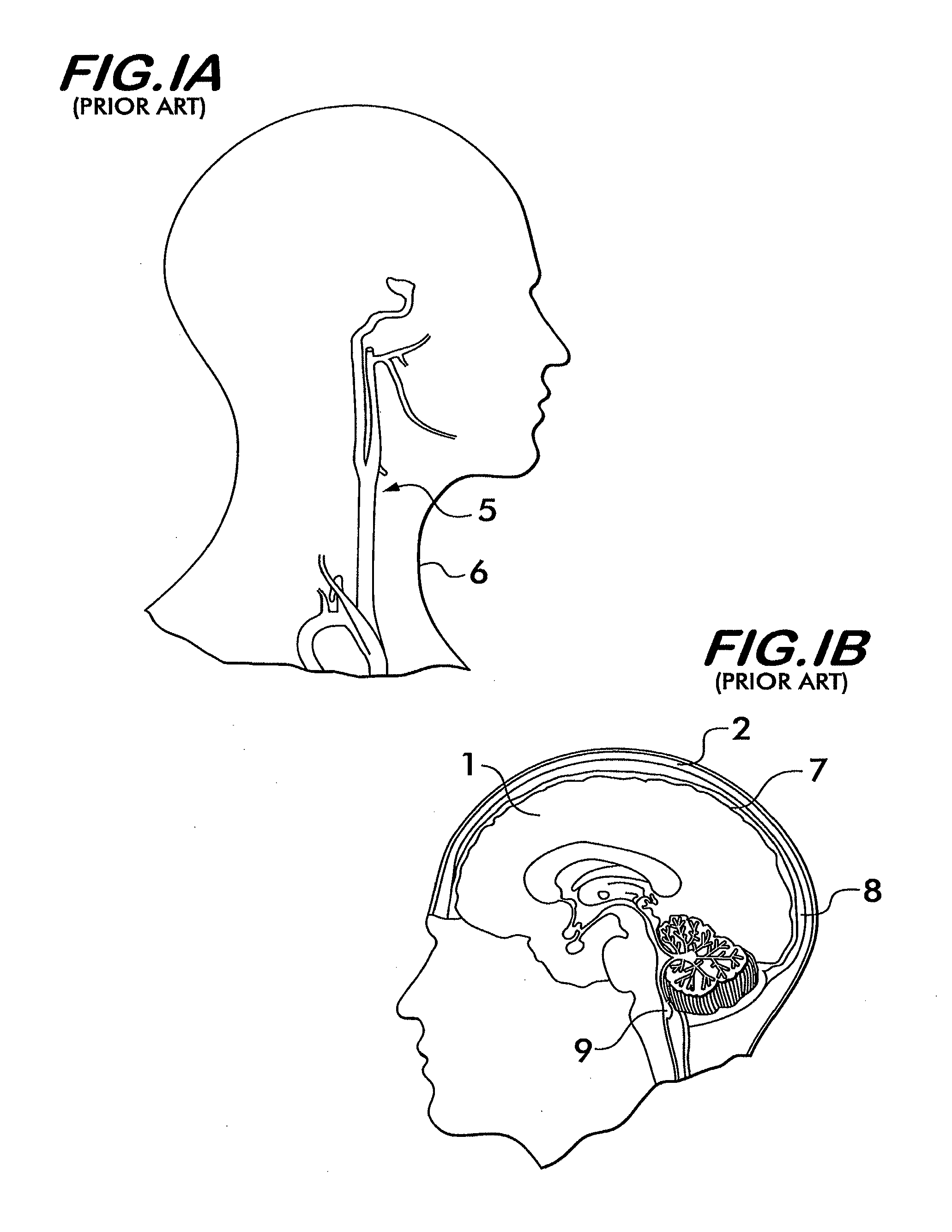 Non-invasive intracranial pressure sensor