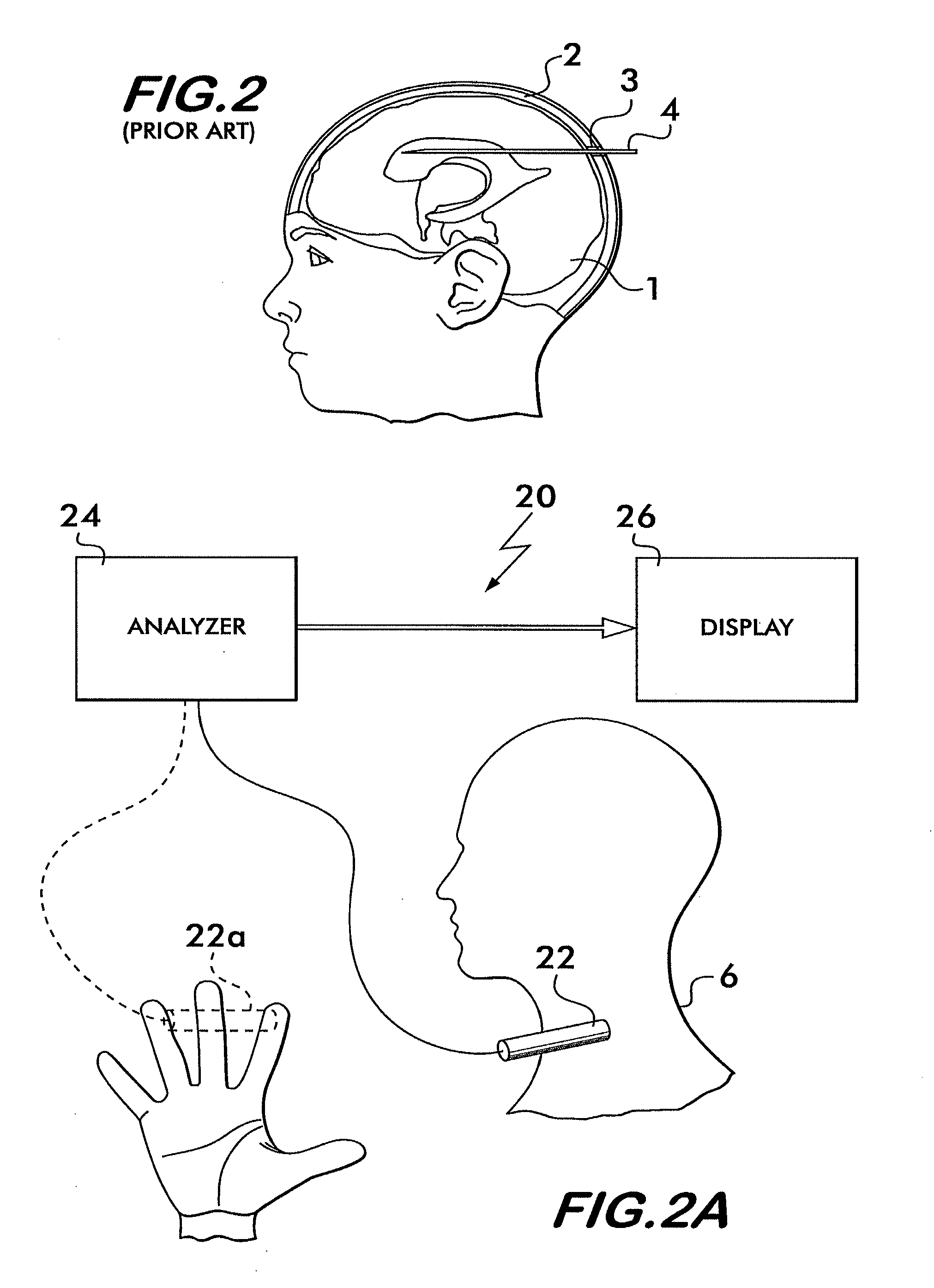 Non-invasive intracranial pressure sensor