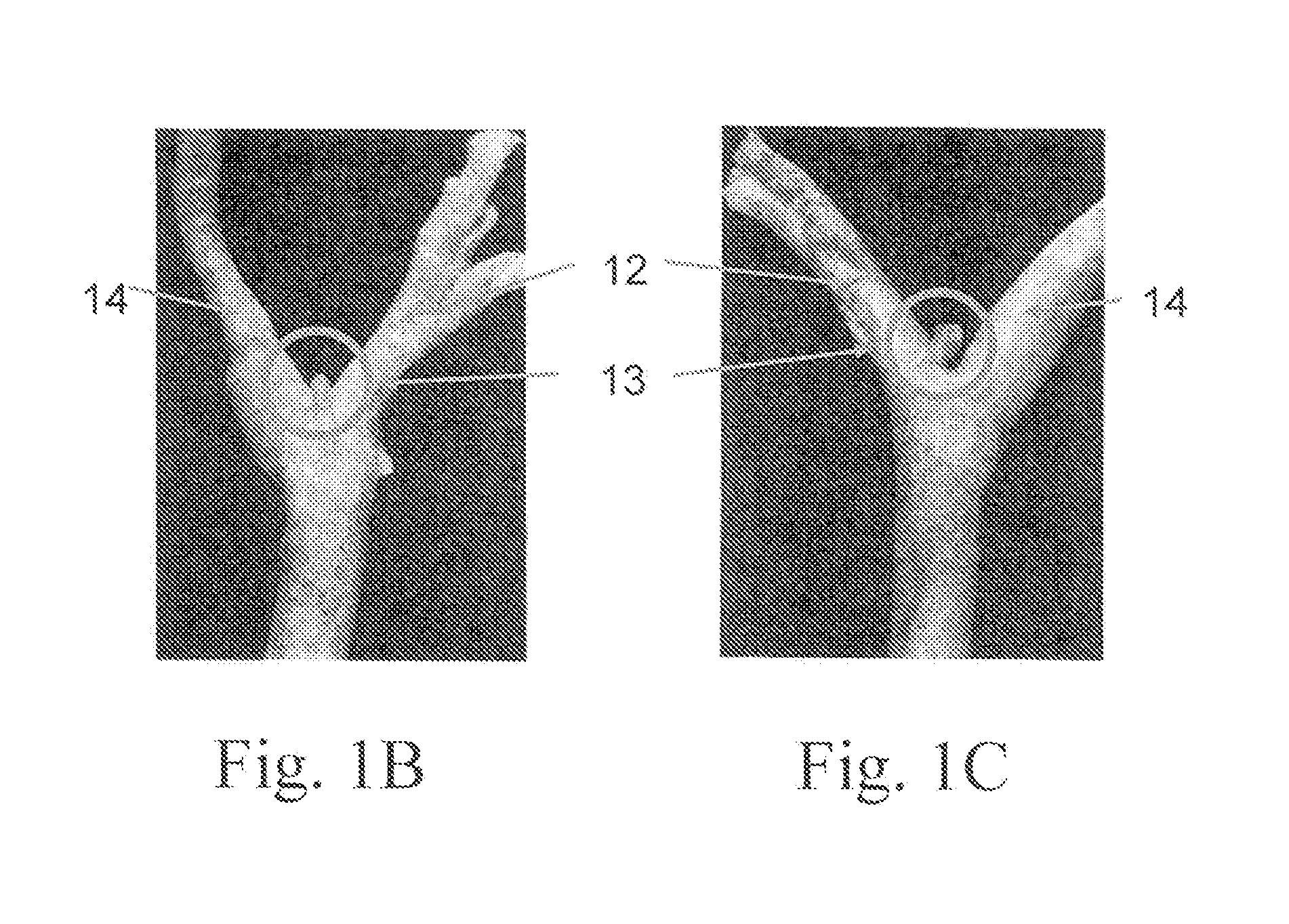 Electrostimulation in treating cerebrovascular conditions