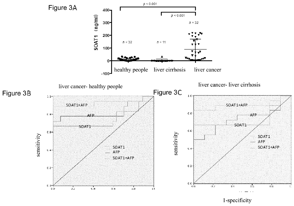 Use of acyl coenzyme a: cholesterol acyltransferase-1 in diagnosis and treatment of liver cancer