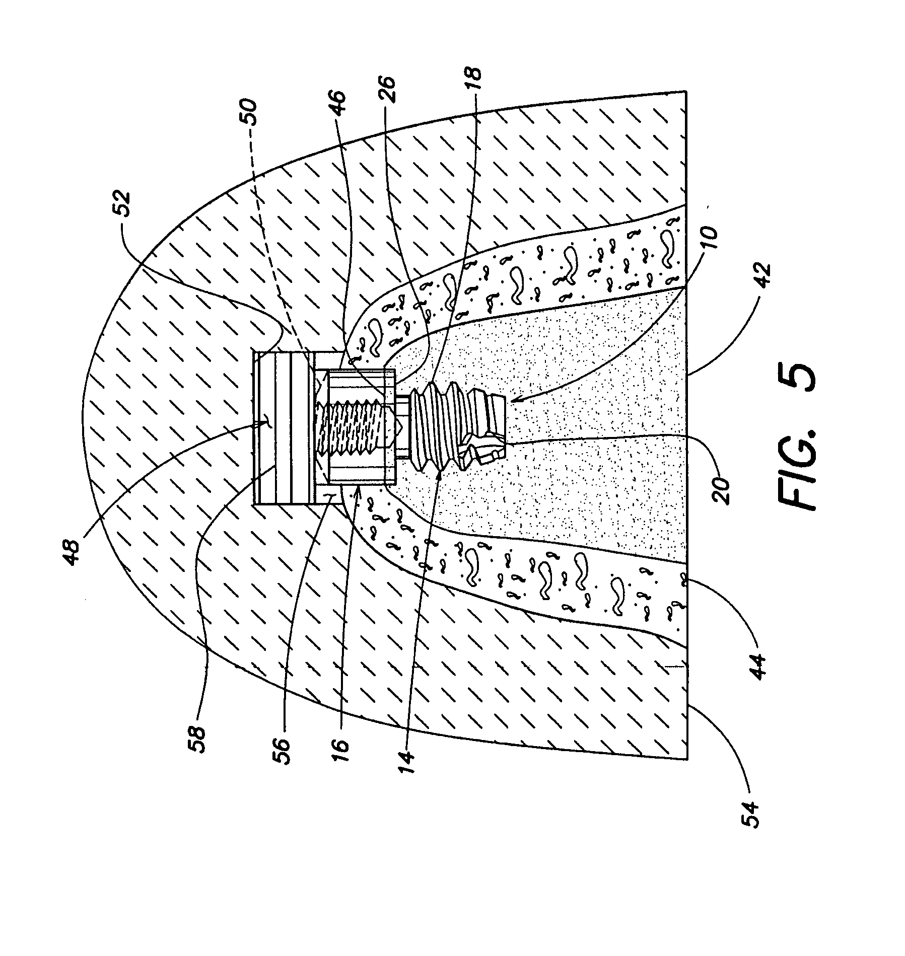 Dental implant for supporting a dental prosthesis