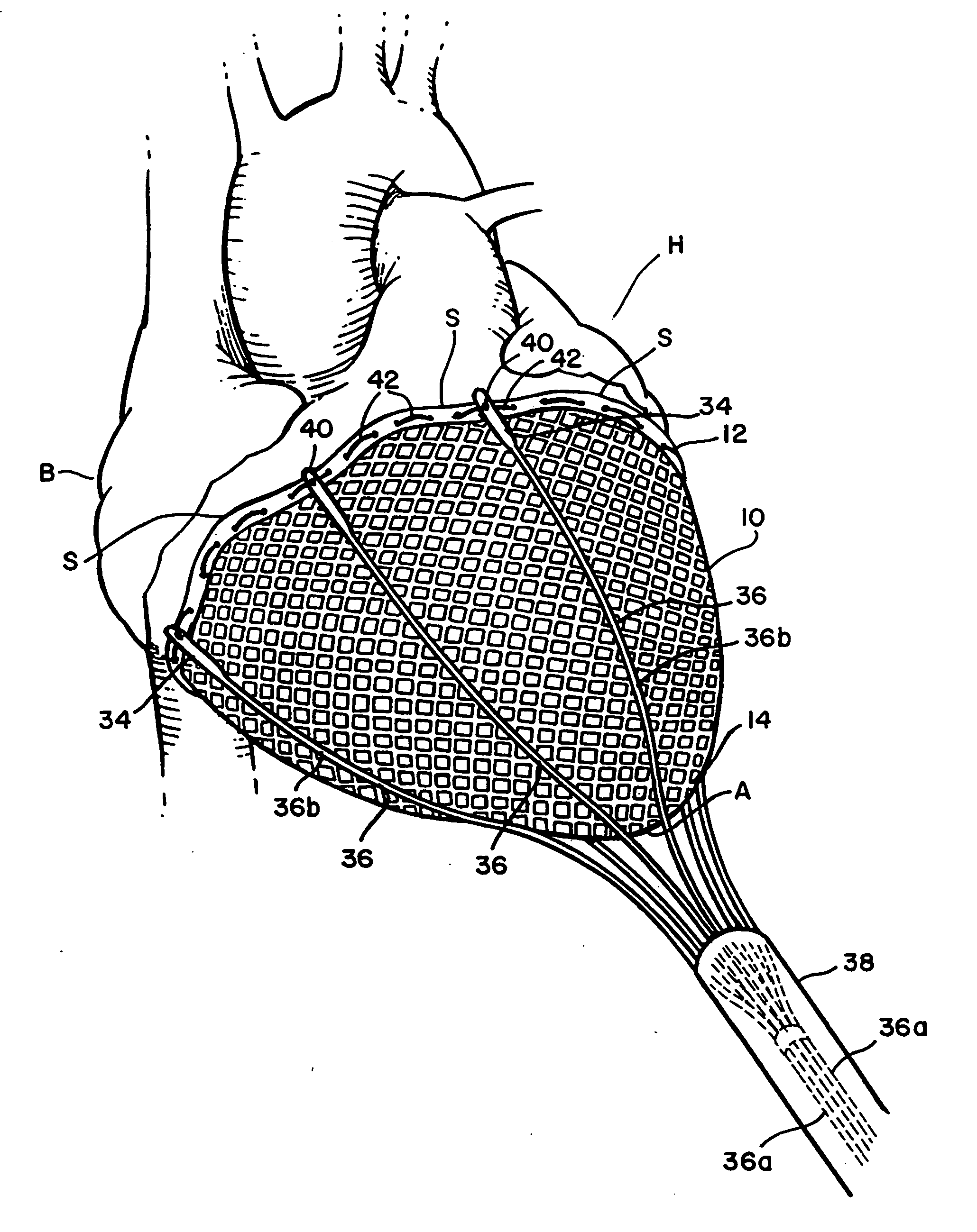 Delivery of cardiac constraint jacket