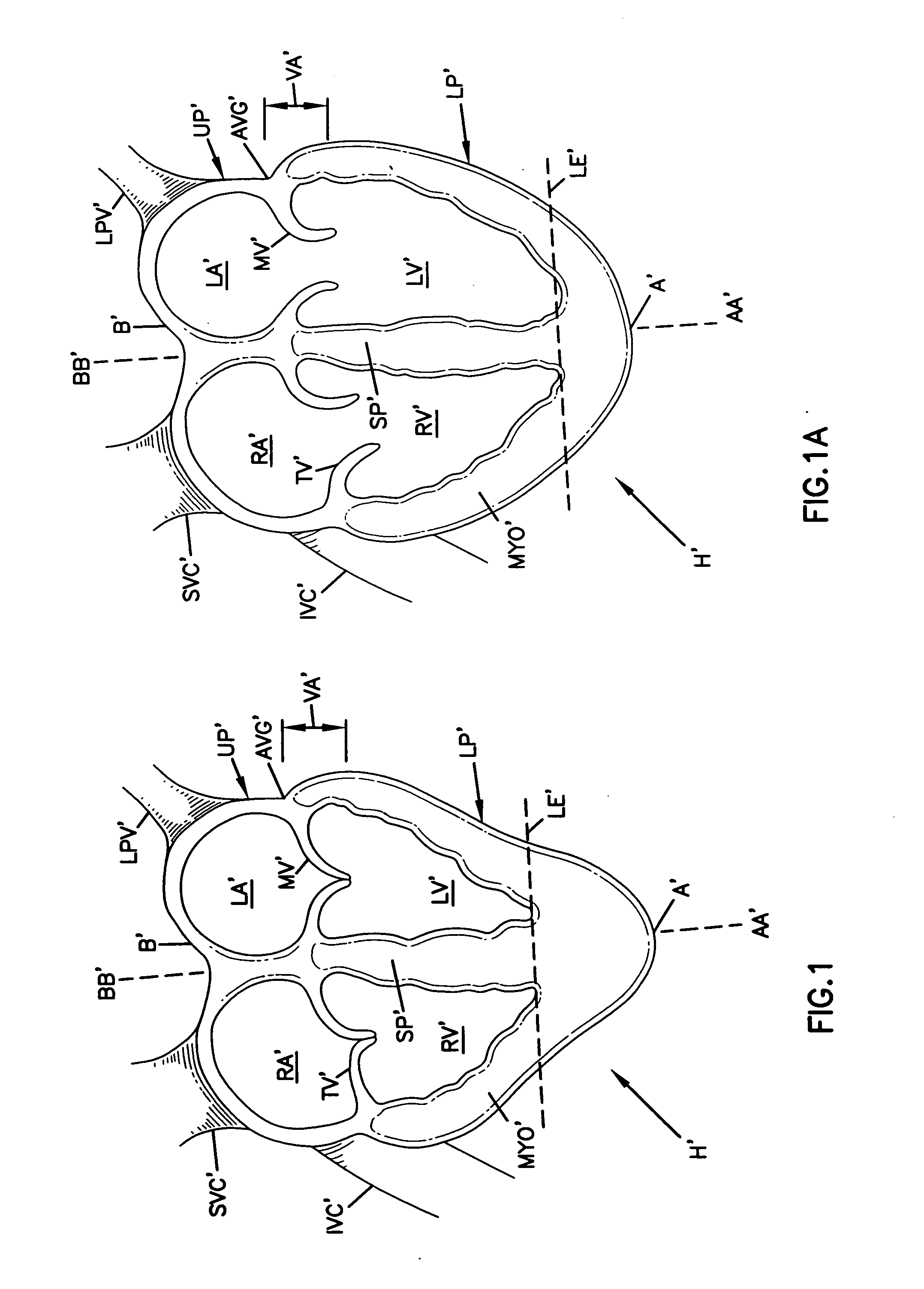 Delivery of cardiac constraint jacket