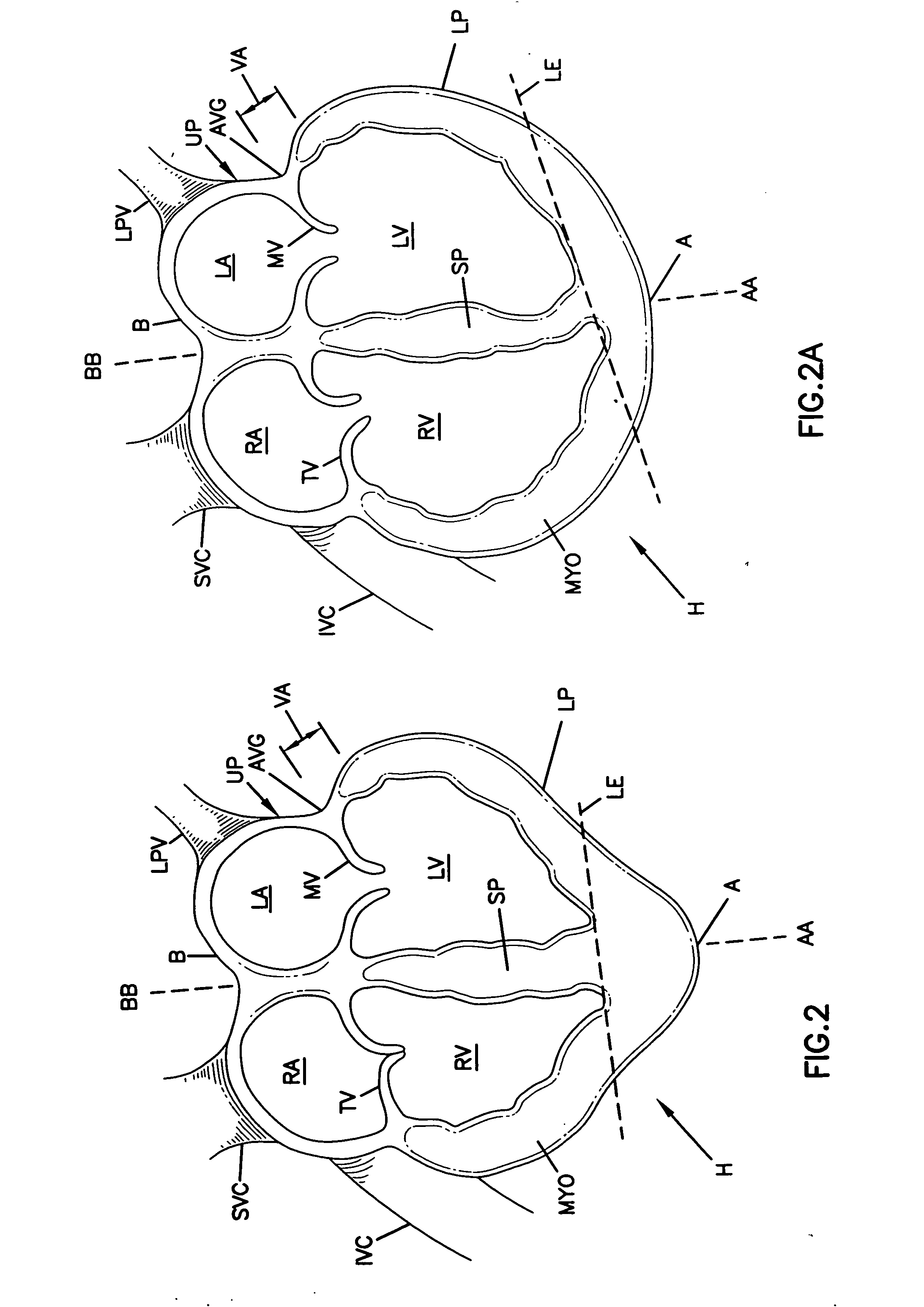 Delivery of cardiac constraint jacket