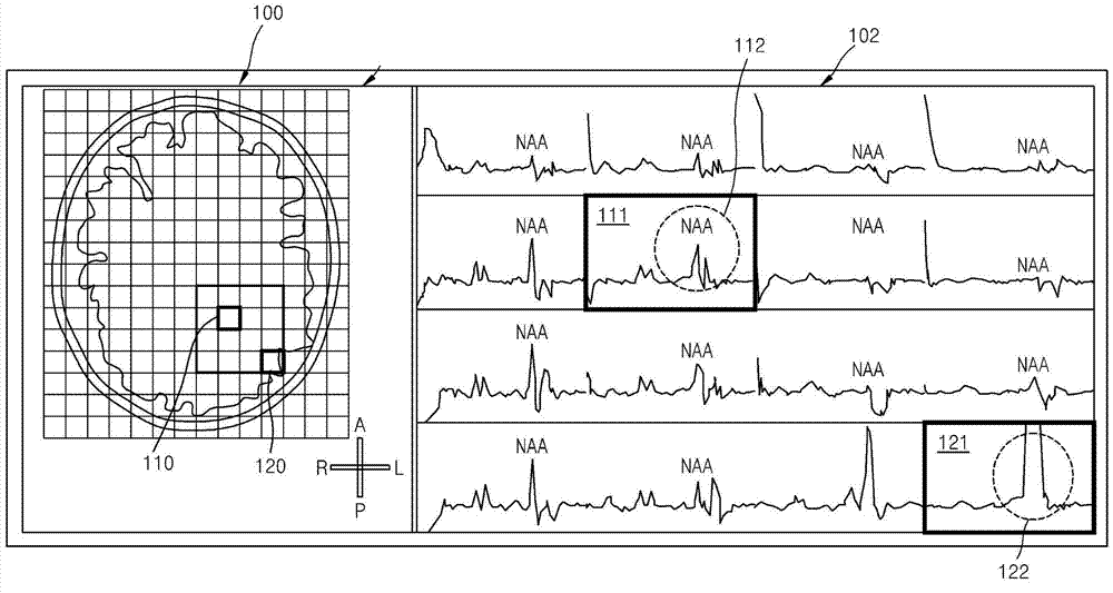 Method and apparatus for removing distortion by lipids from magnetic resonance spectroscopic image