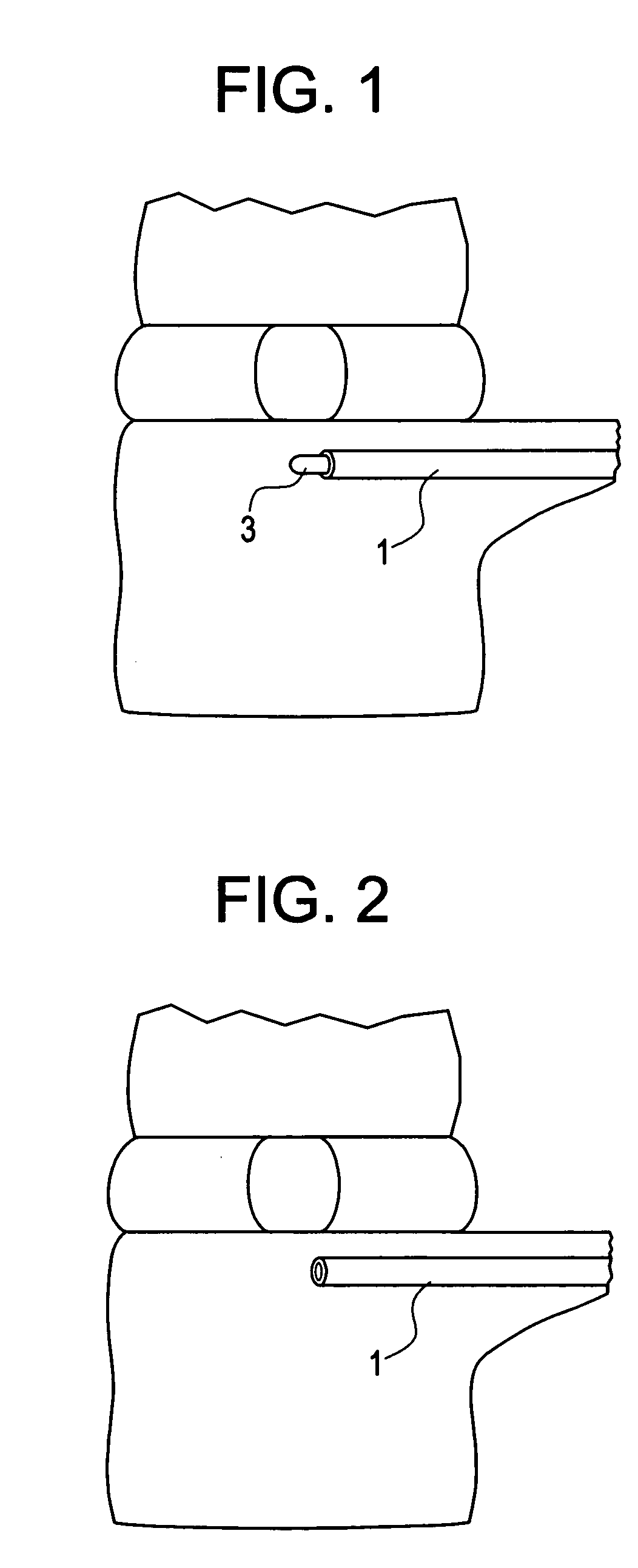 Method and instruments for intervertebral disc augmentation through a pedicular approach