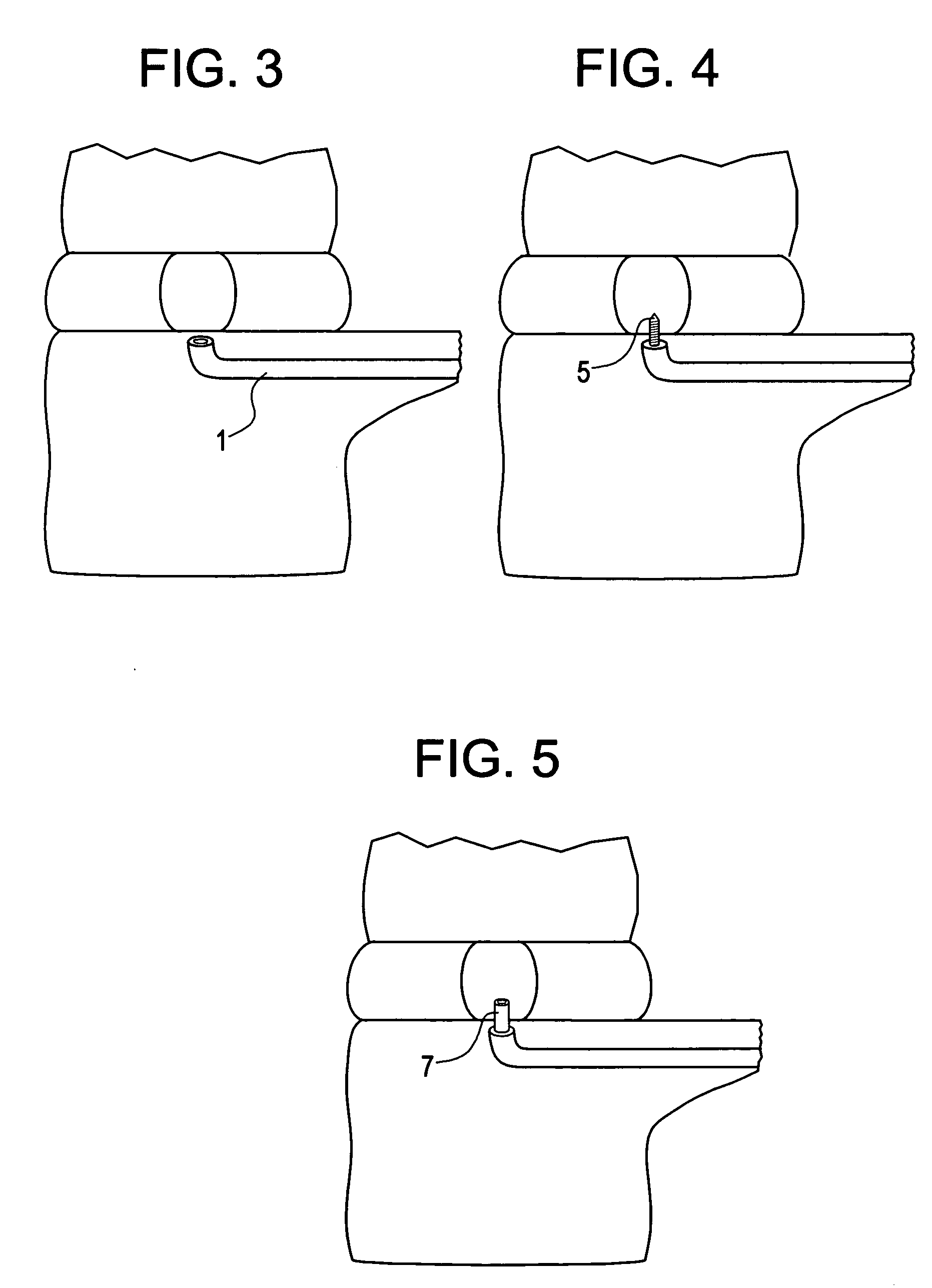 Method and instruments for intervertebral disc augmentation through a pedicular approach