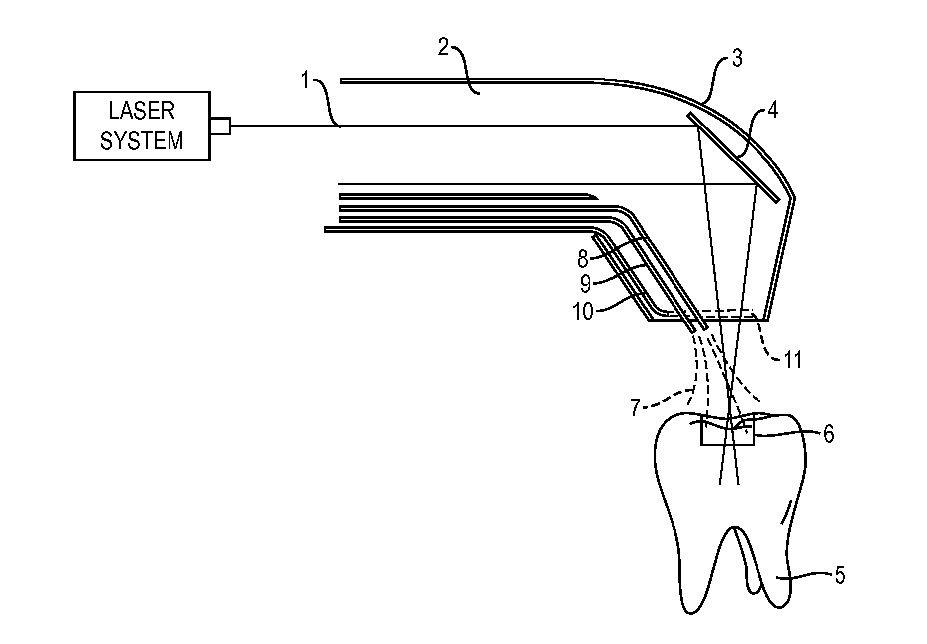 Apparatus and Method for Controlled Fluid Cooling During Laser Based Dental Treatments