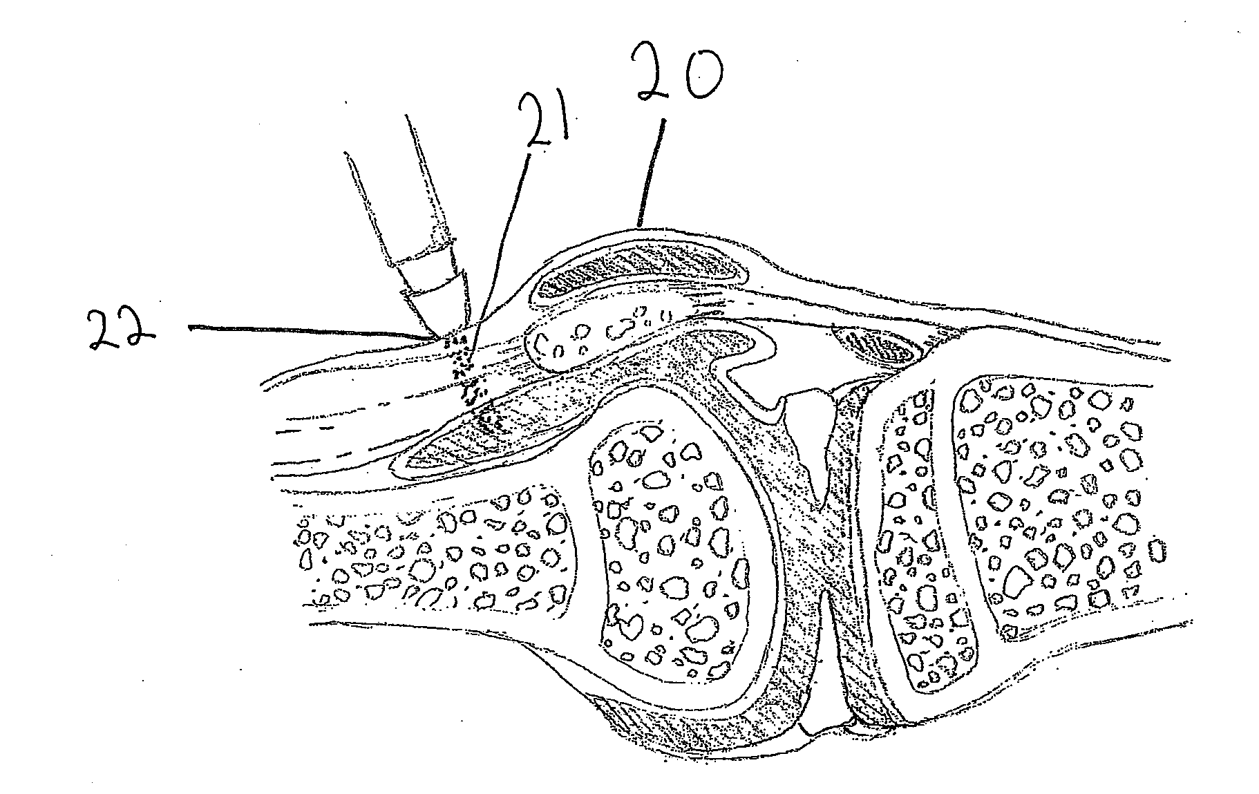 Device and method for treating musculo-skeletal injury and pain by application of laser light therapy