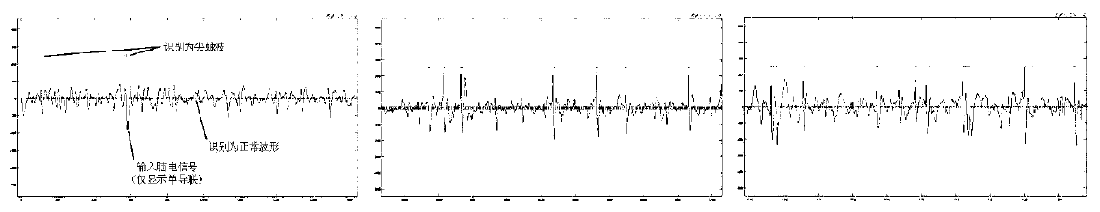 Combined detection method of electroencephalogram epilepsy sharp and spike wave discharge based on long short term memory network (LSTM) multi-channels