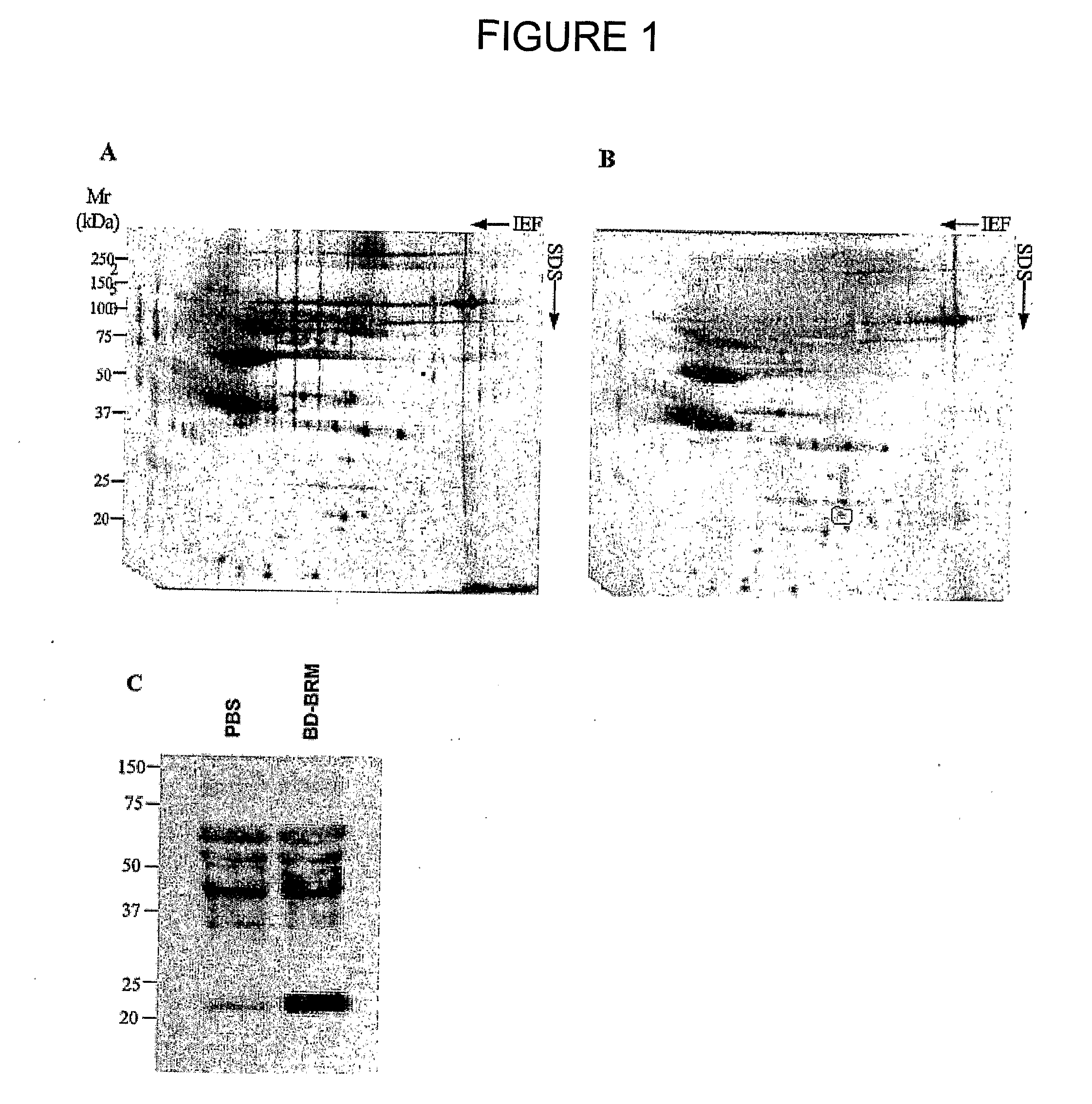 Use of interleukin 17e for the treatment of cancer