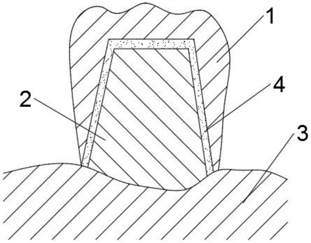 3D printing manufacturing method of pure titanium dental crown