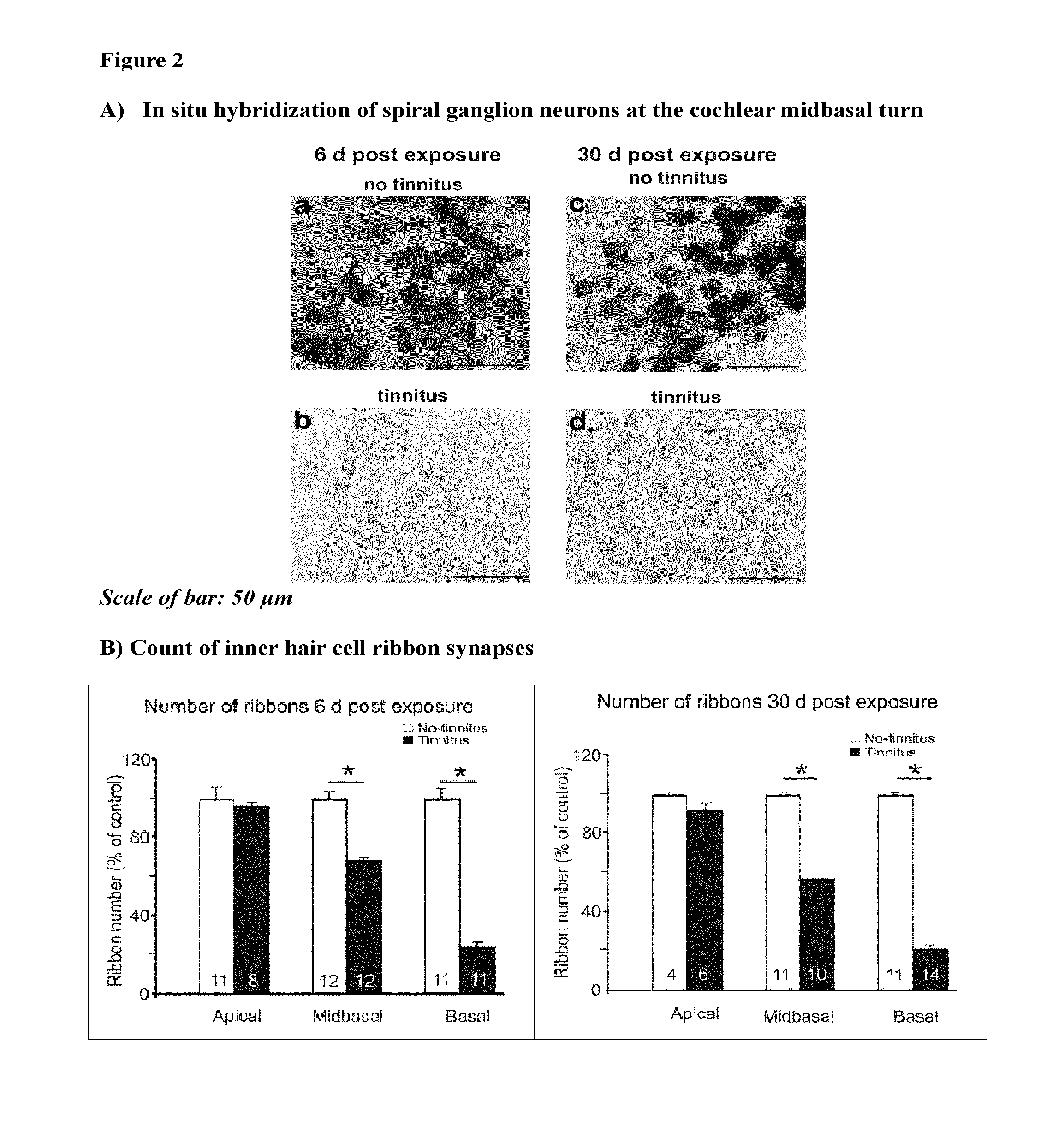 Treatment of tinnitus through modulation of chloride co-transporter nkcc1 in the auditory system