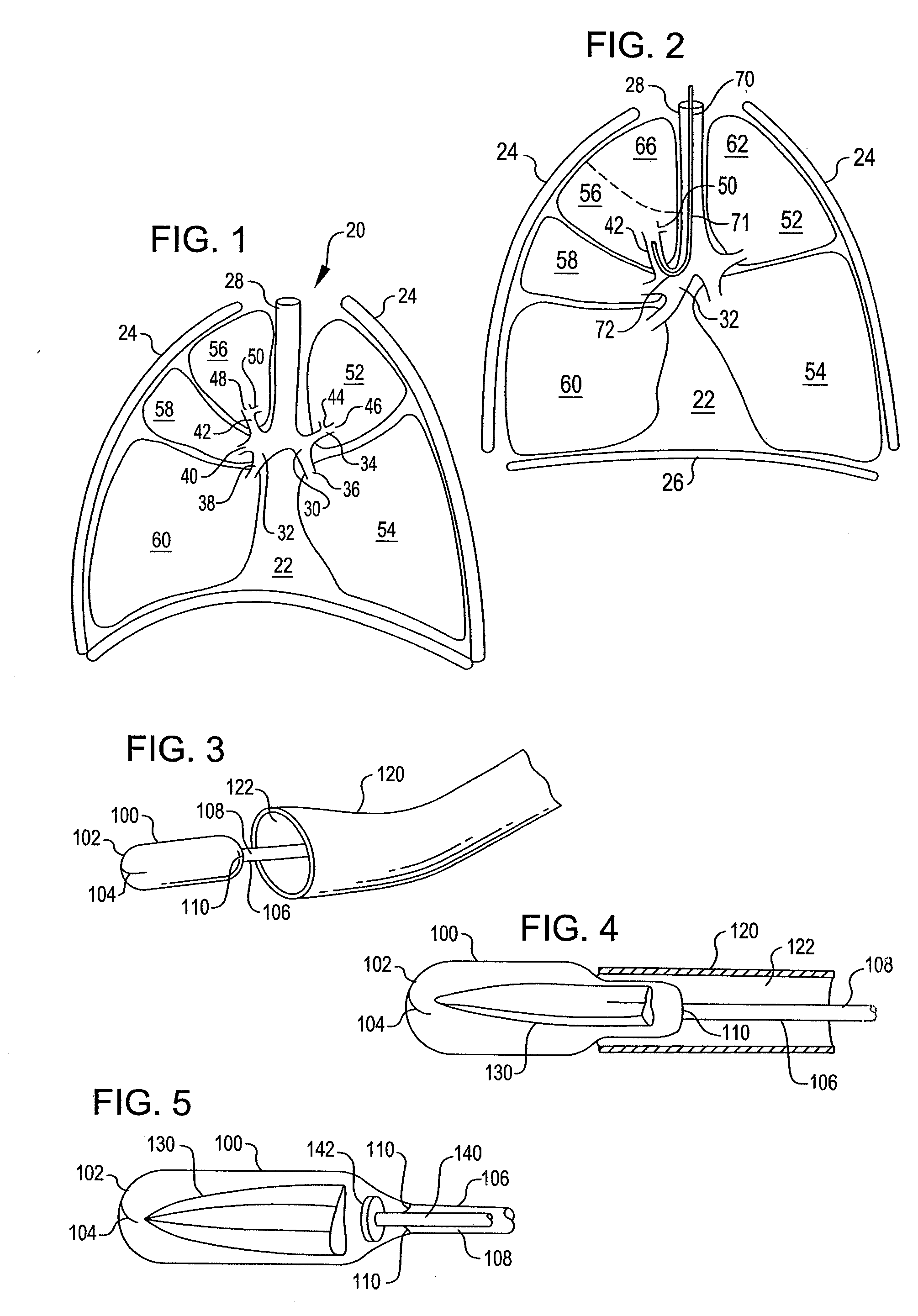 Apparatus and method for deployment of a bronchial obstruction device