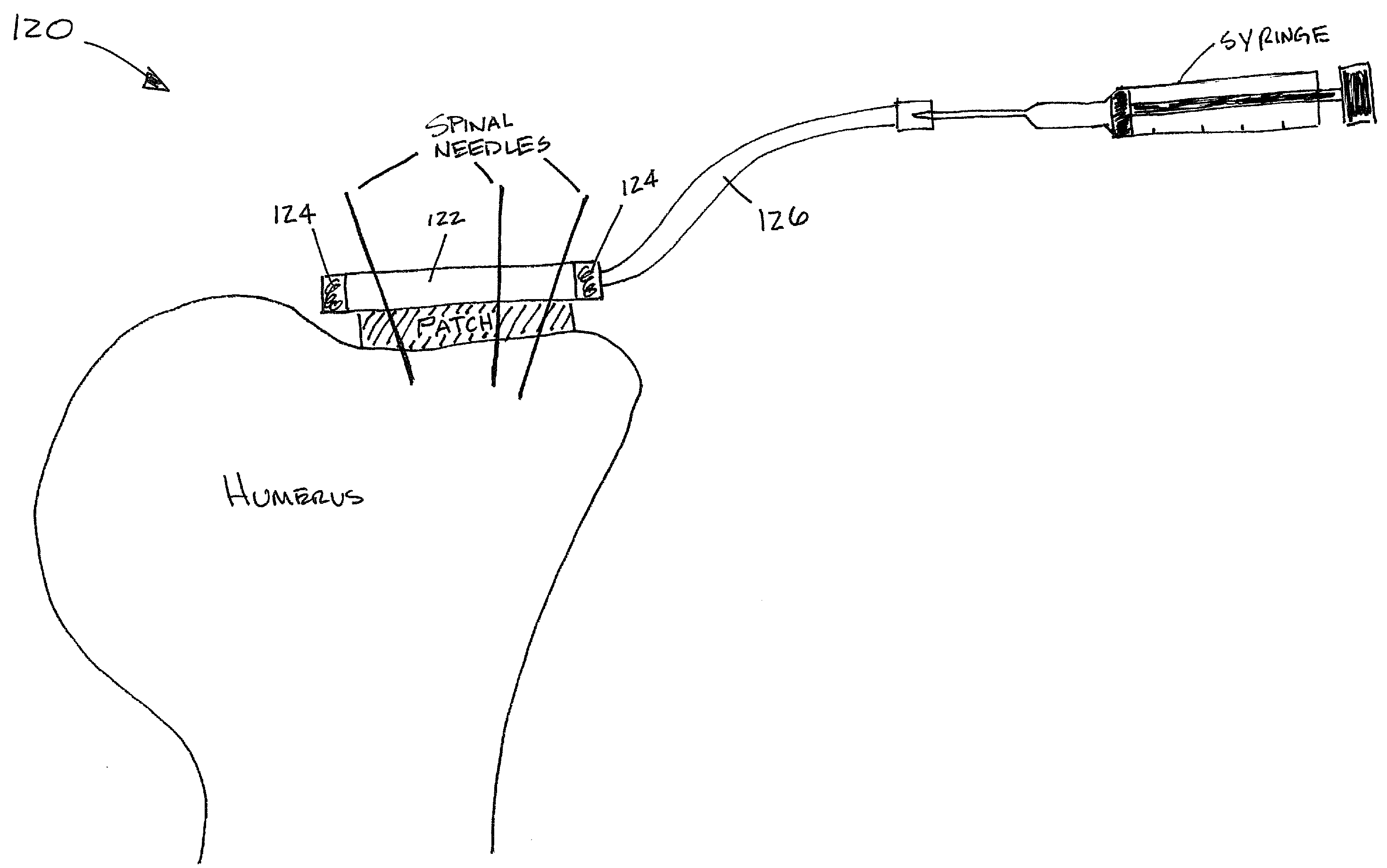 Rotator cuff patch delivery device