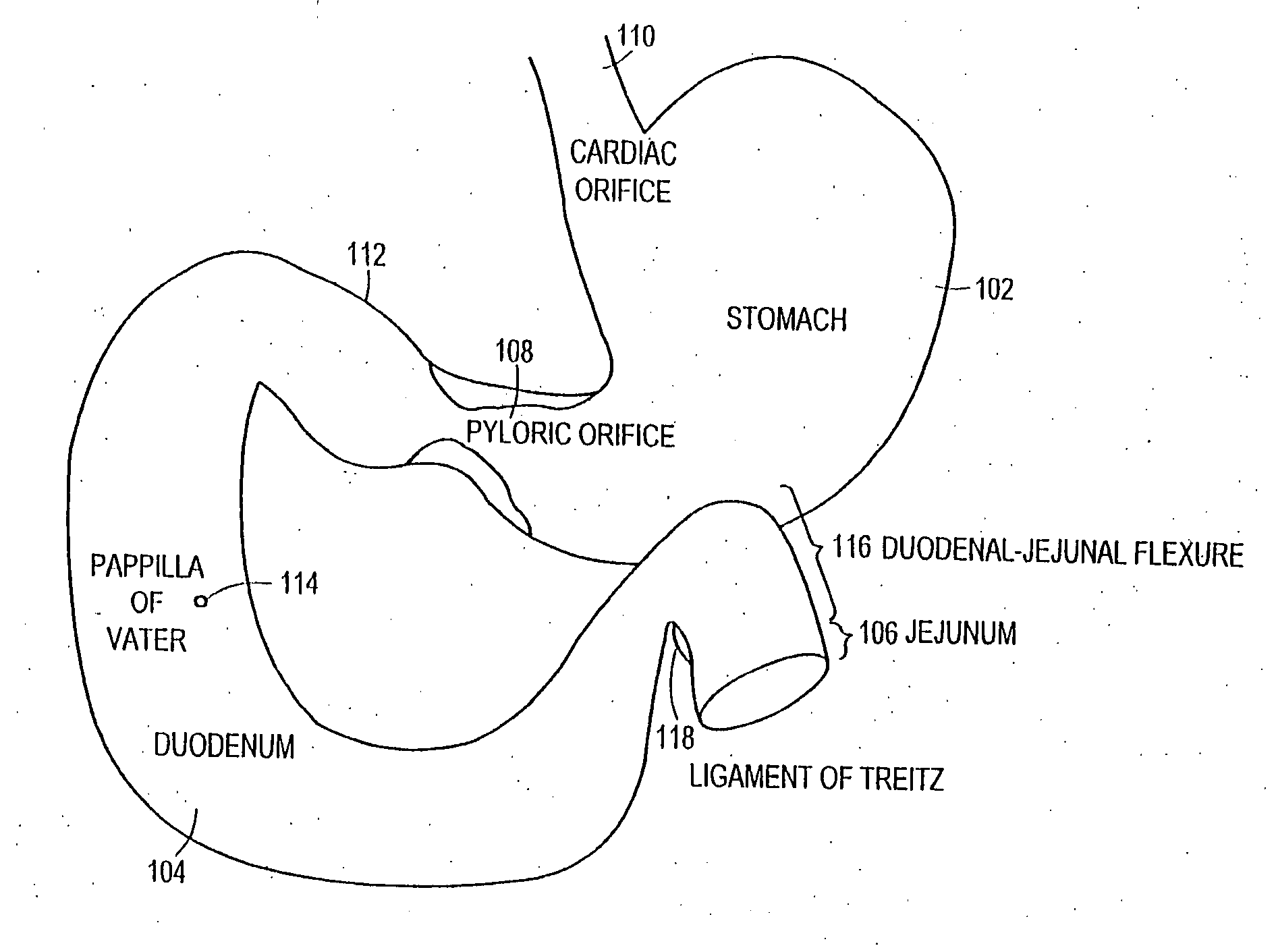 Bariatric sleeve