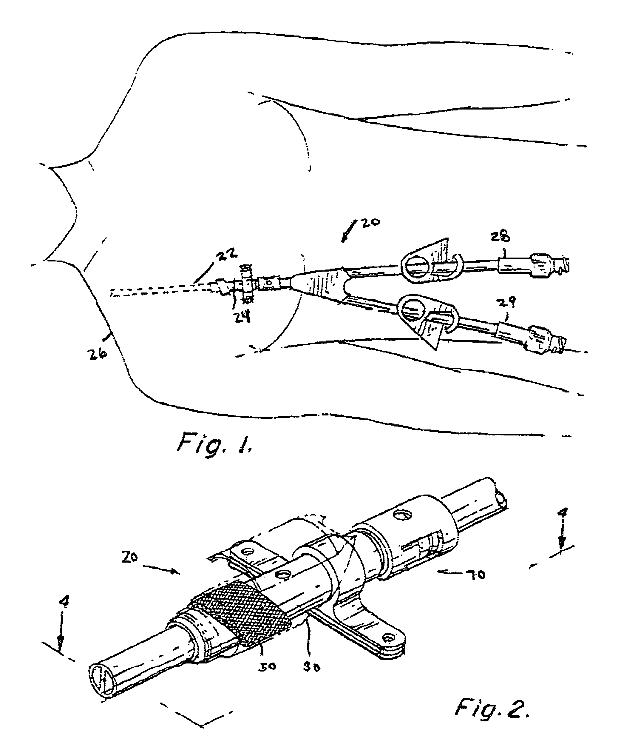 Apparatus and method for facilitating the replacement of an implanted catheter