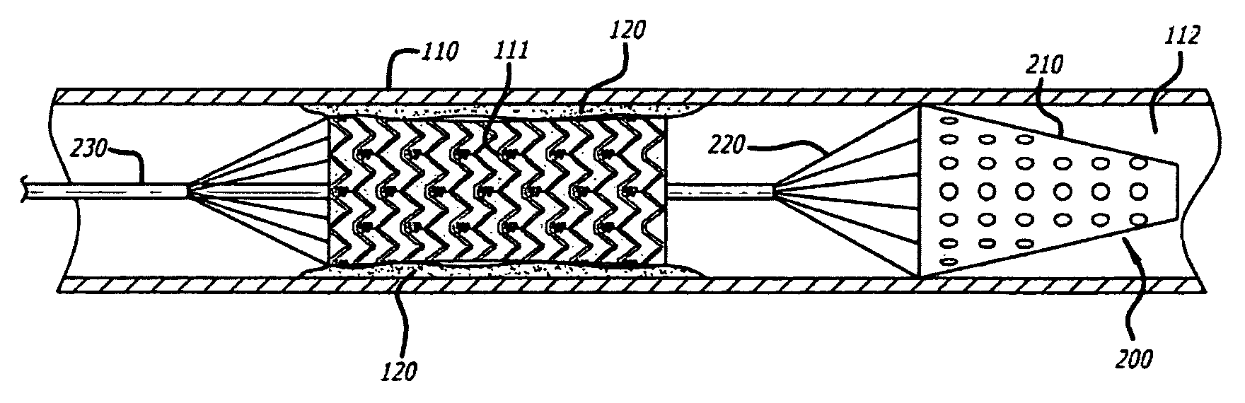 Embolus removal systems with baskets