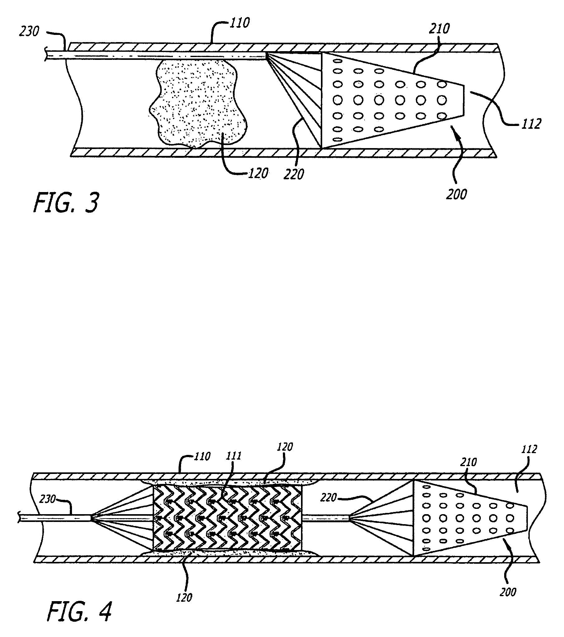 Embolus removal systems with baskets