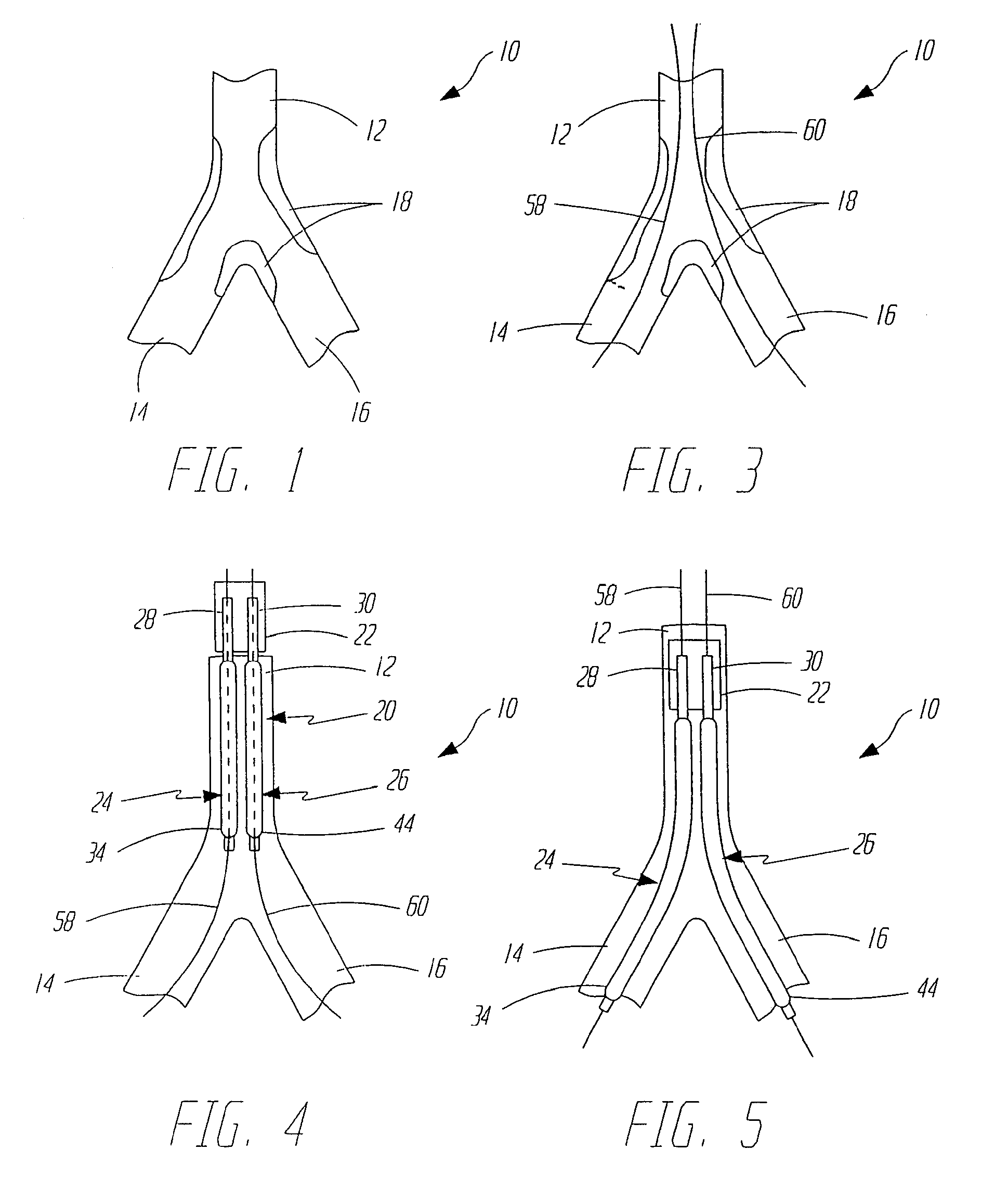 Dilation and Stent Delivery System for Bifurcation Lesions